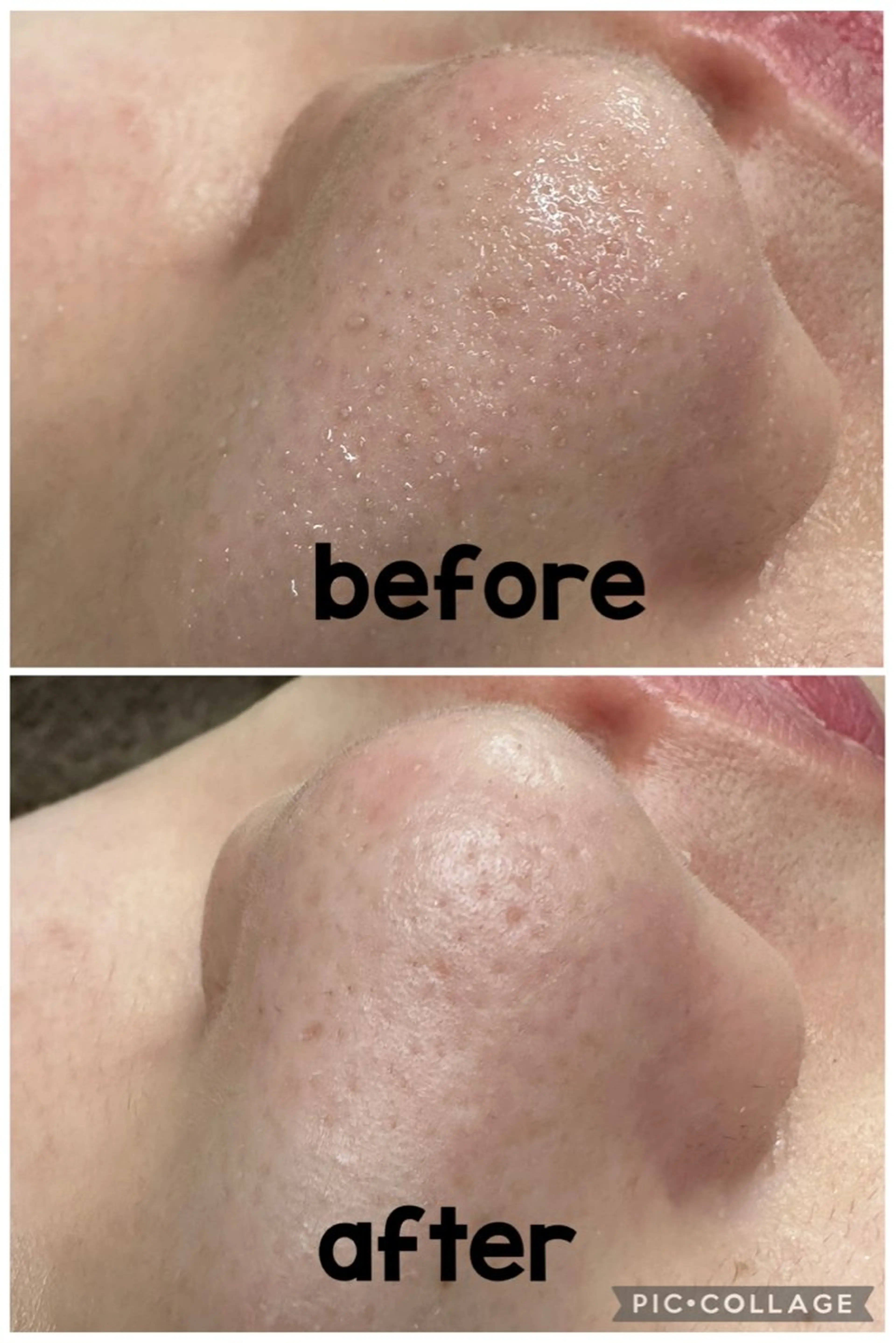 毛穴洗浄、ソニックエステ、パックの写真