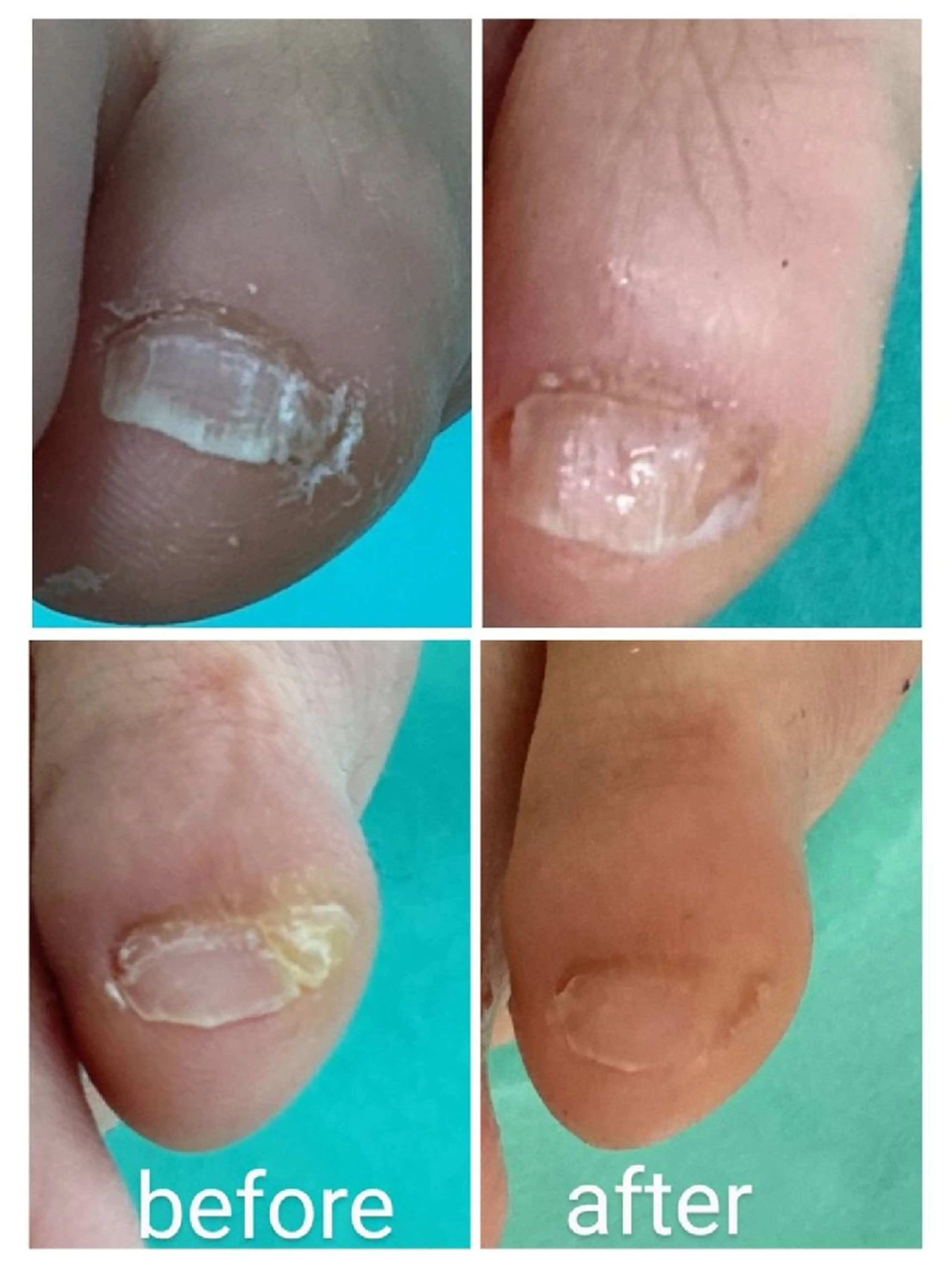 その他(ネイル) 巻き爪補正店 大阪なんば店のネイルデザイン