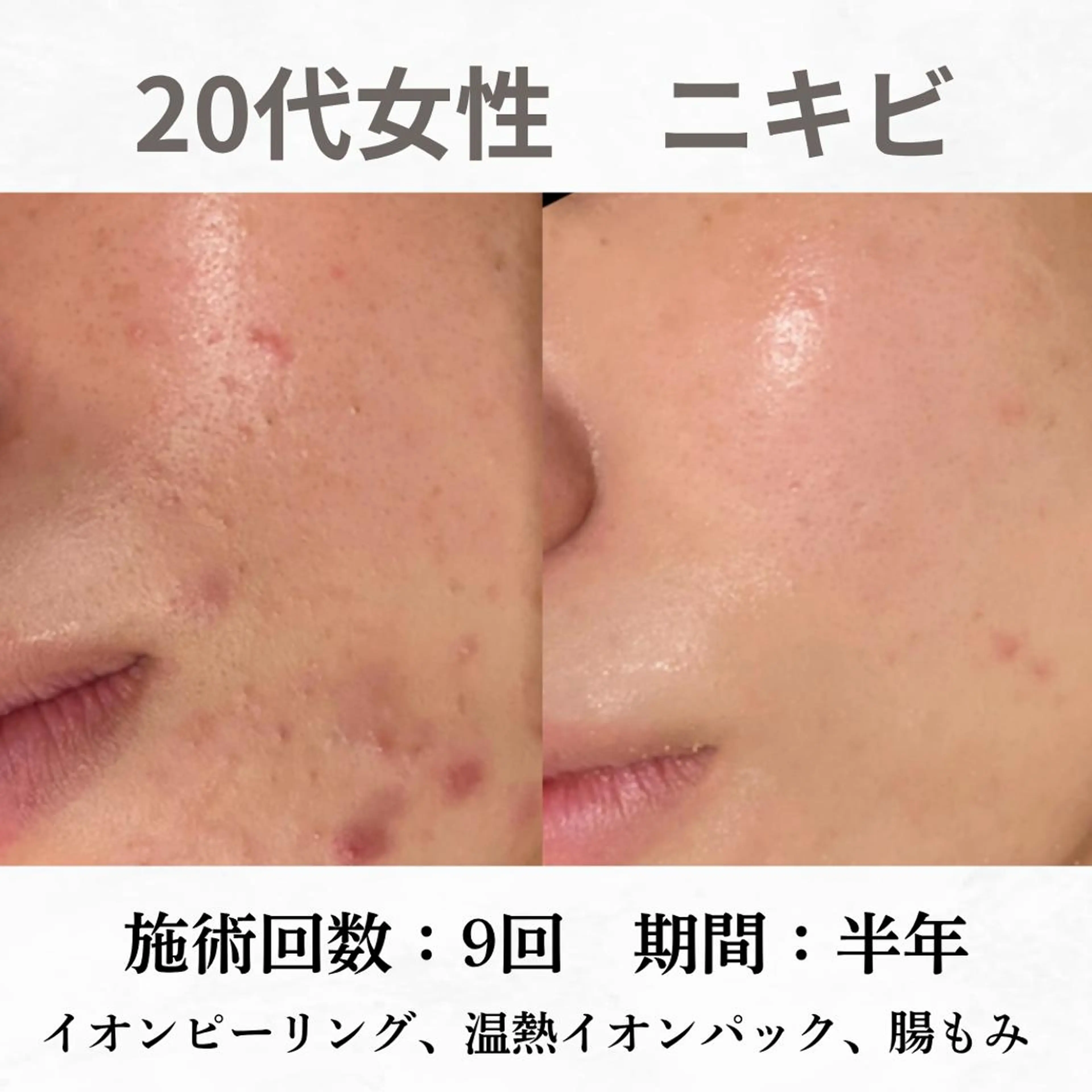 重度ニキビ専門🌷 ダウンタイムなしのエステ・リラクイメージ