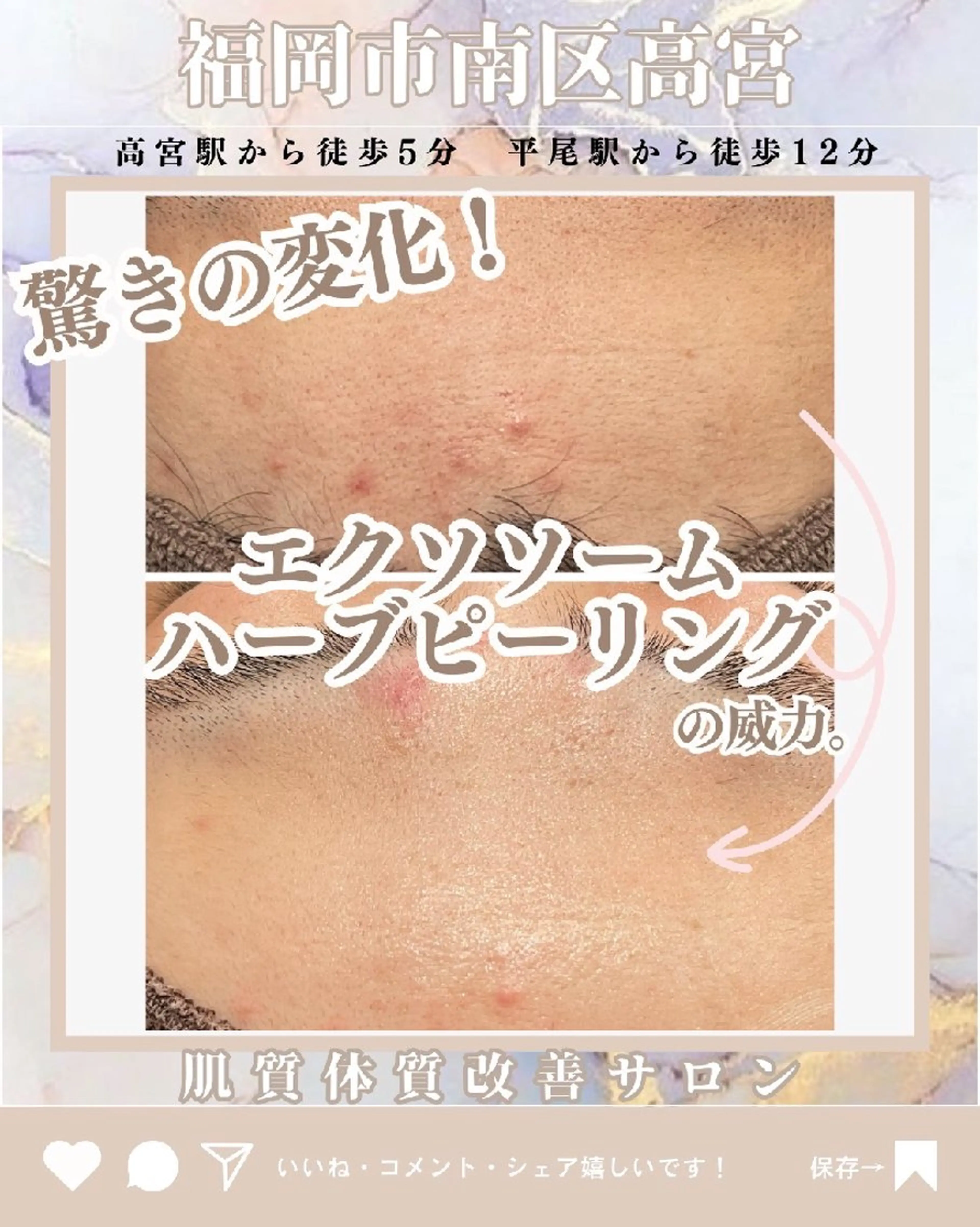 悩むあなたにスペシャルケア【毛穴洗浄+再生修復ハープピーリング】23000円→10,000円の写真