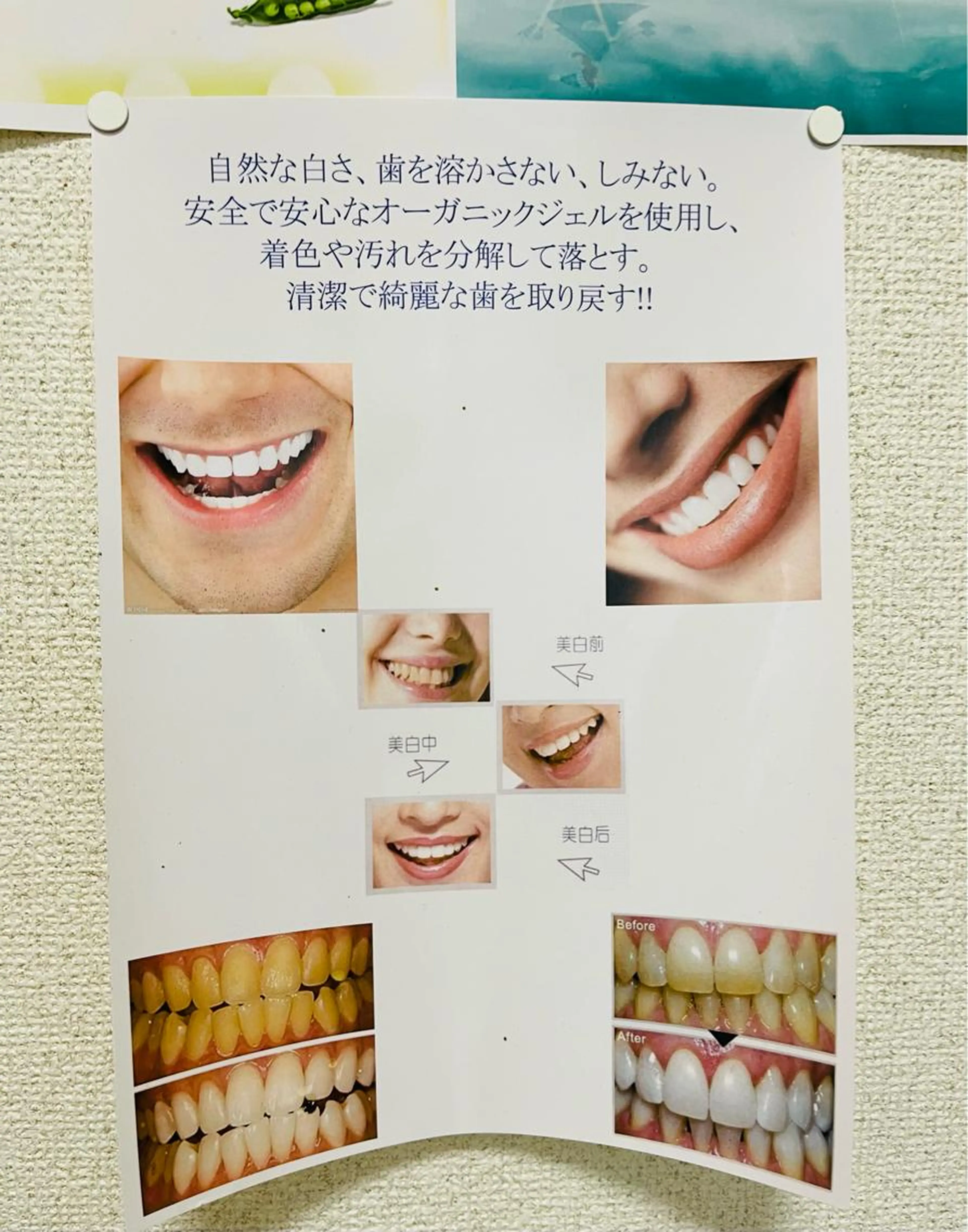 歯のホワイトニングセルフの写真