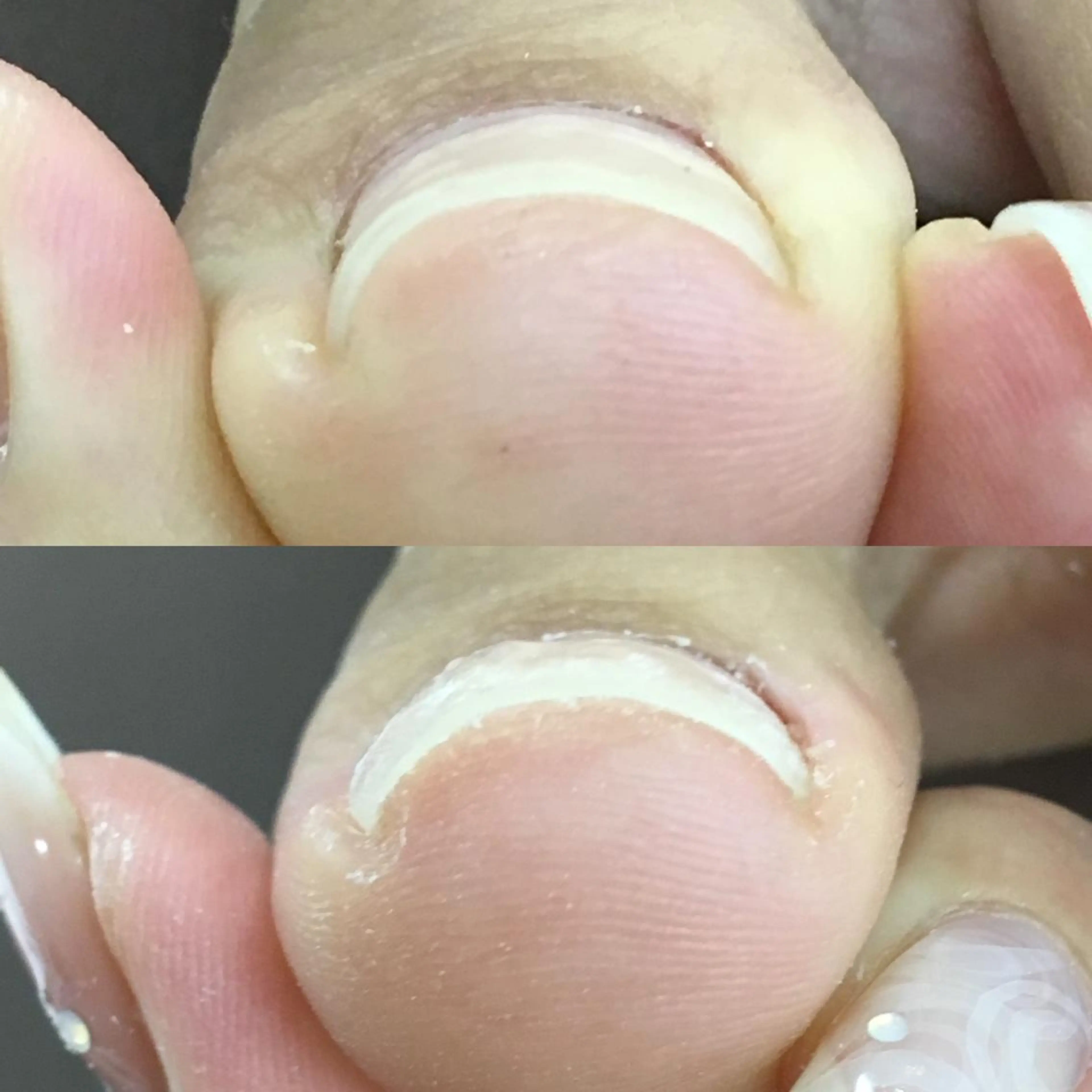 ネイル 自爪育成・巻き爪 補正講師　津蔵のネイルデザイン