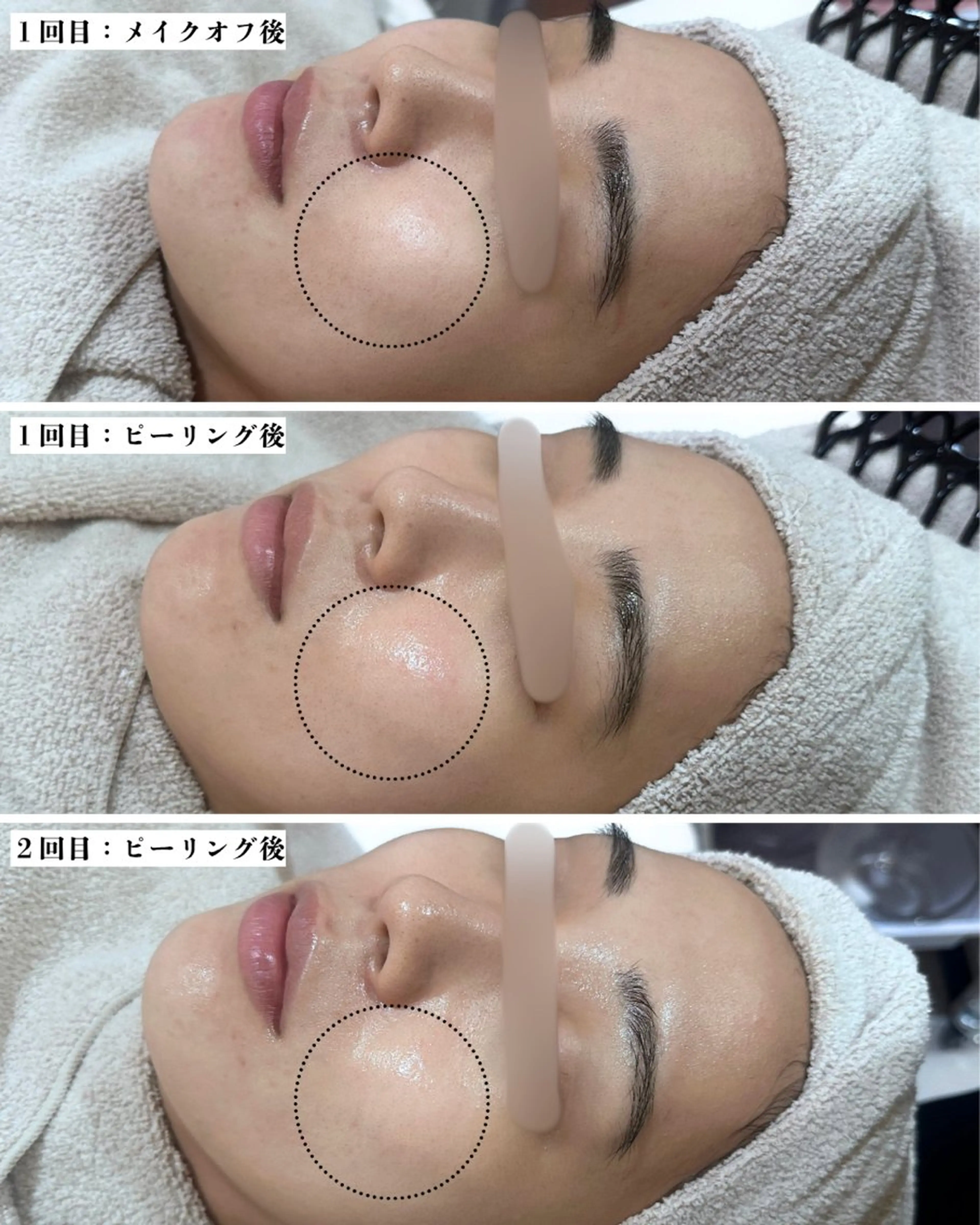 エステ |ピーリング・毛穴| soina神楽坂のエステ・リラクイメージ