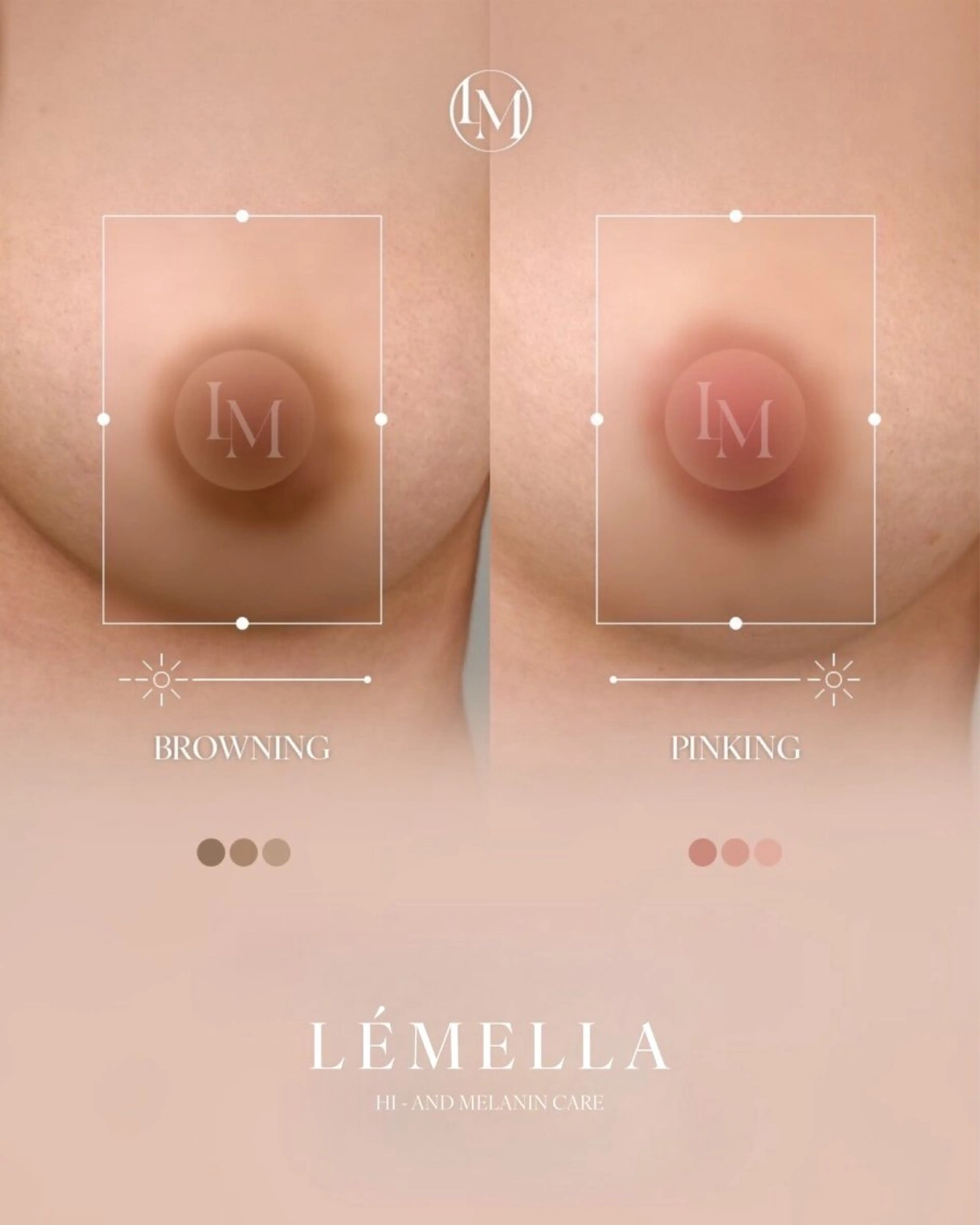 韓国No.1シェア【メラニン除去ケア】 バストトップ＊アフタークリーム1個(¥17,000)付きの写真