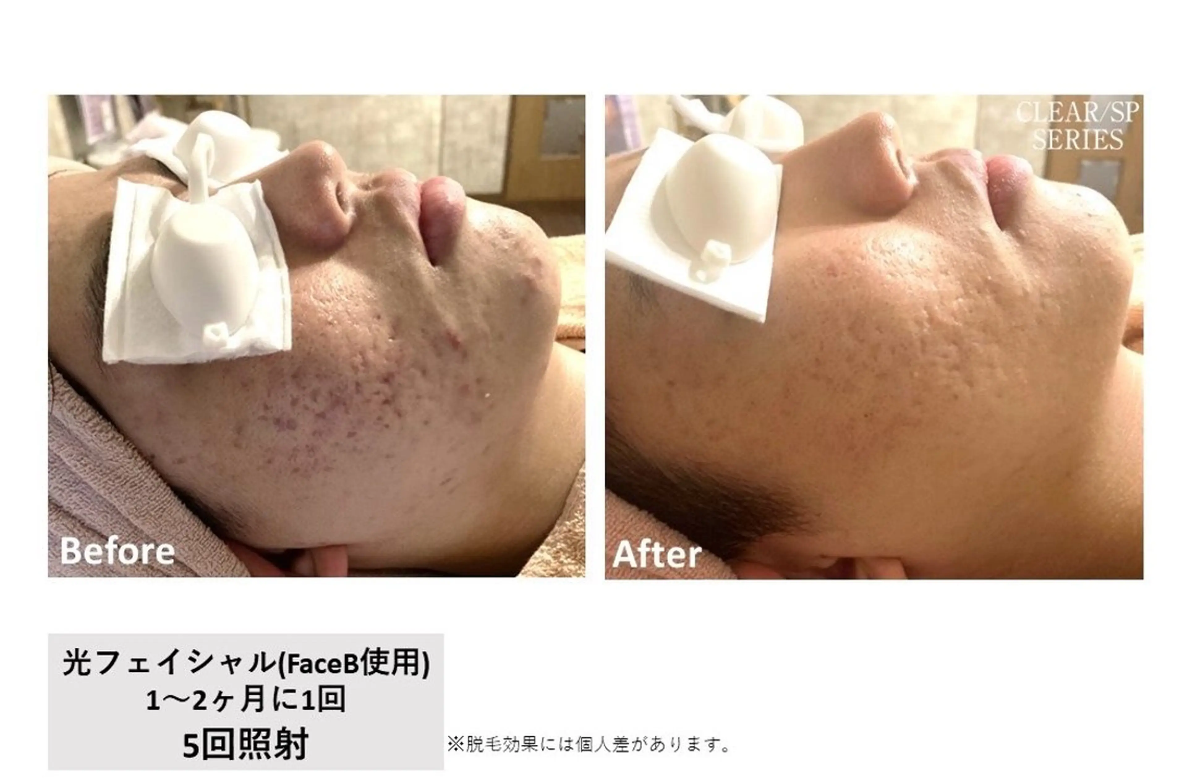 光フェイシャルの写真