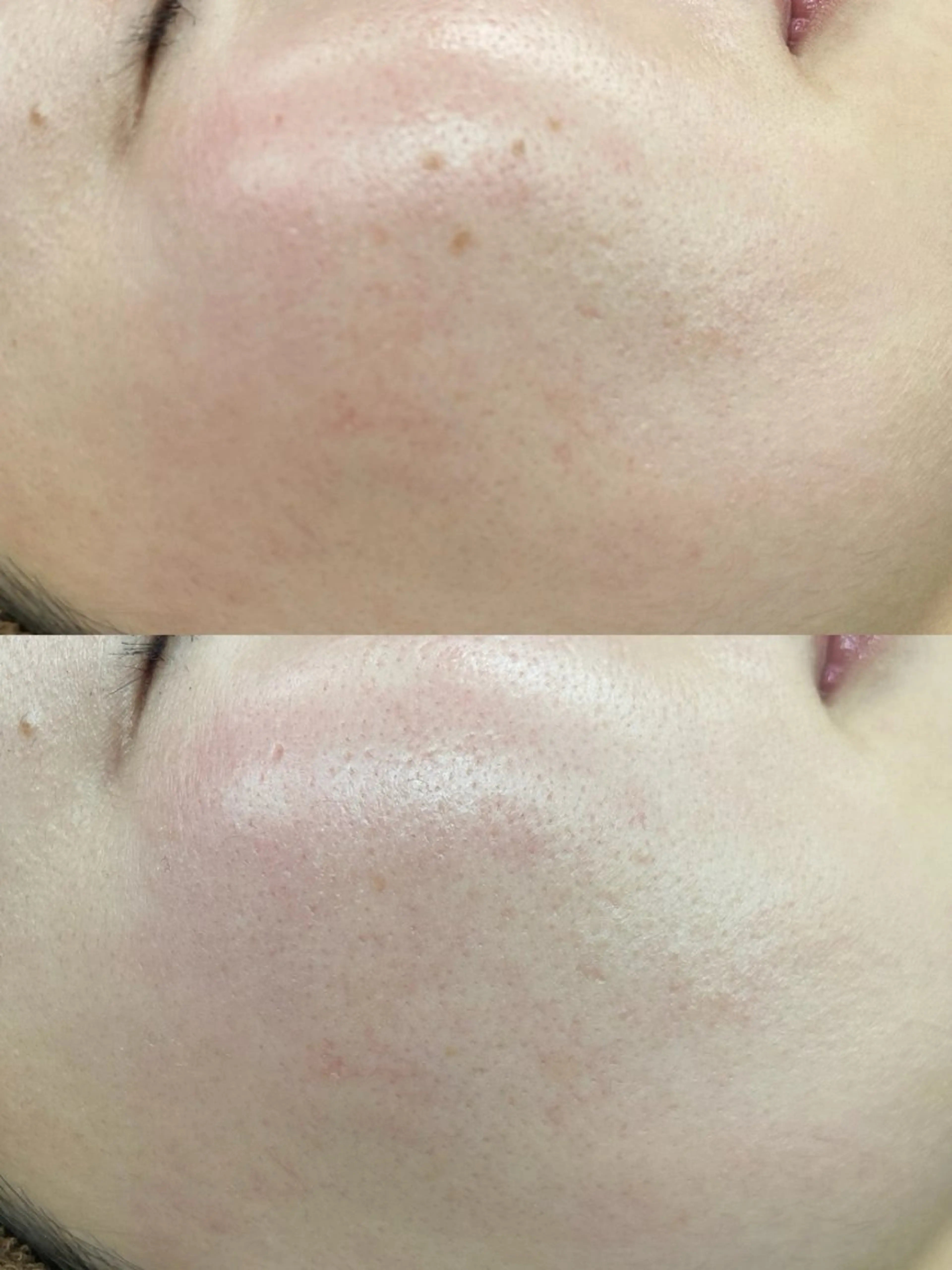 プレミアムプラズマ水素パックトリートメントの写真