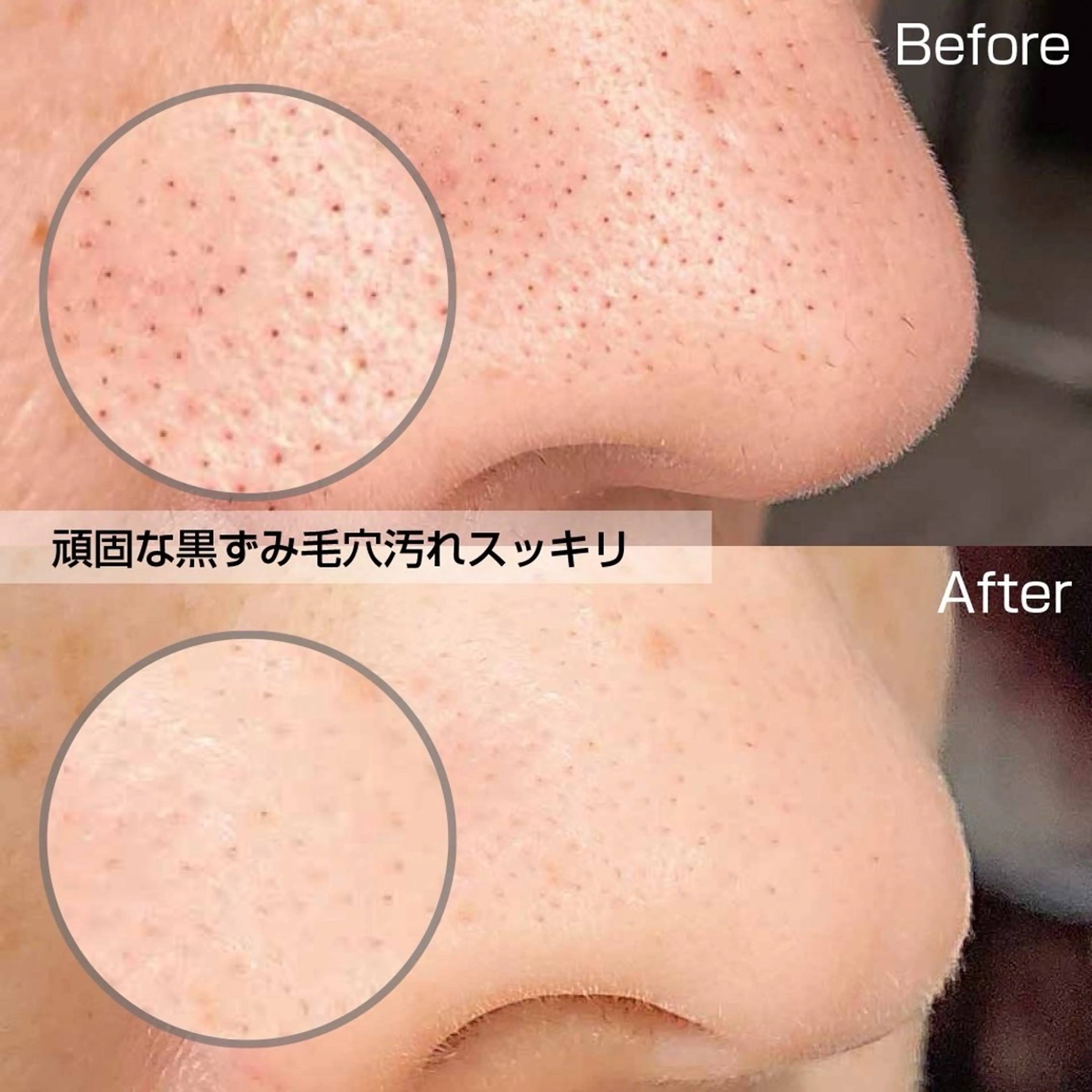 【黒ずみ毛穴・ザラつきに】初回体験ハイドロ＋パックの写真