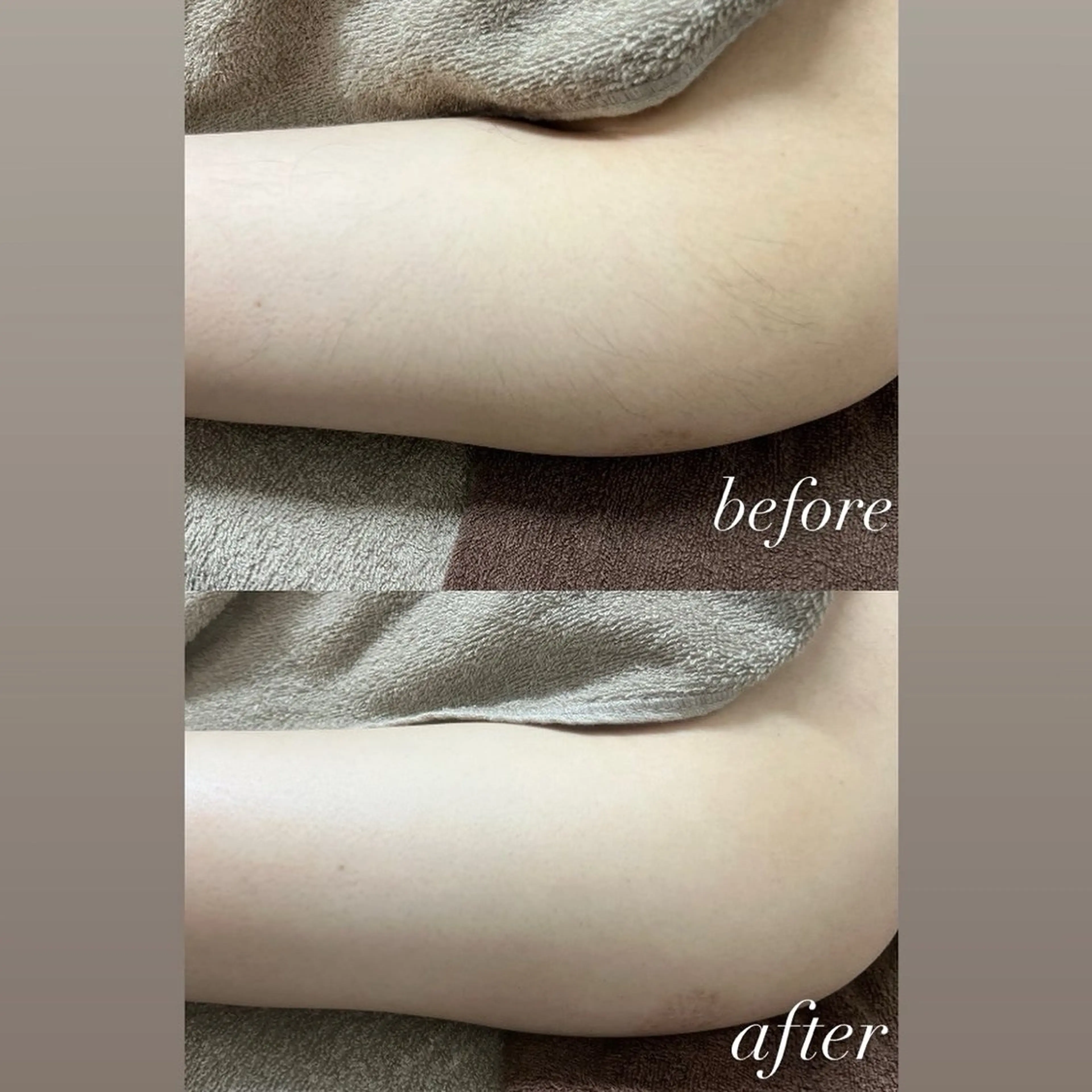 脱毛 smileskin 京都／meguのその他イメージ