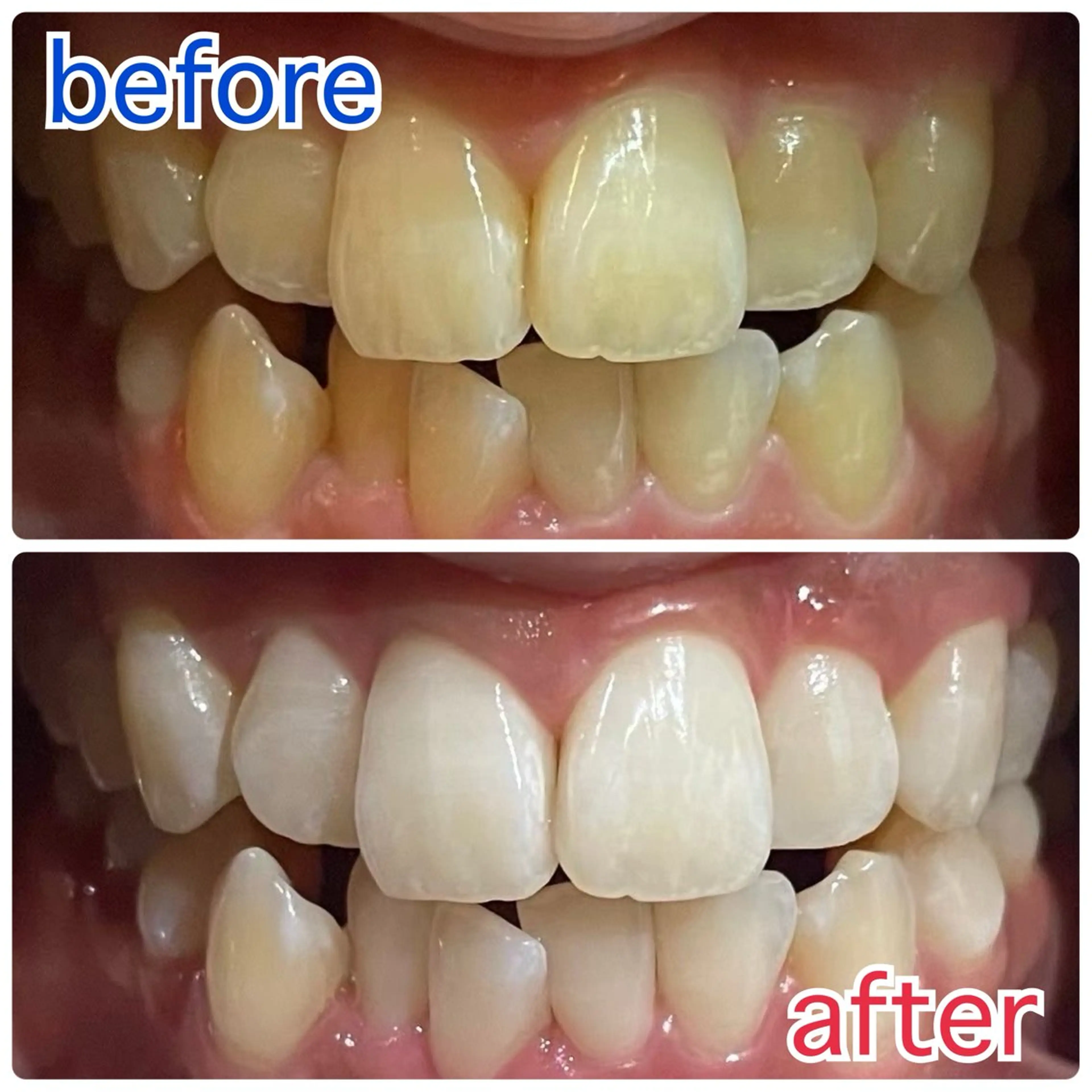 【当日限定✨】セルフホワイトニング体験メニュー!歯の黄ばみに!8分x3回で効果実感セルフで簡単本格ケア🥰の写真