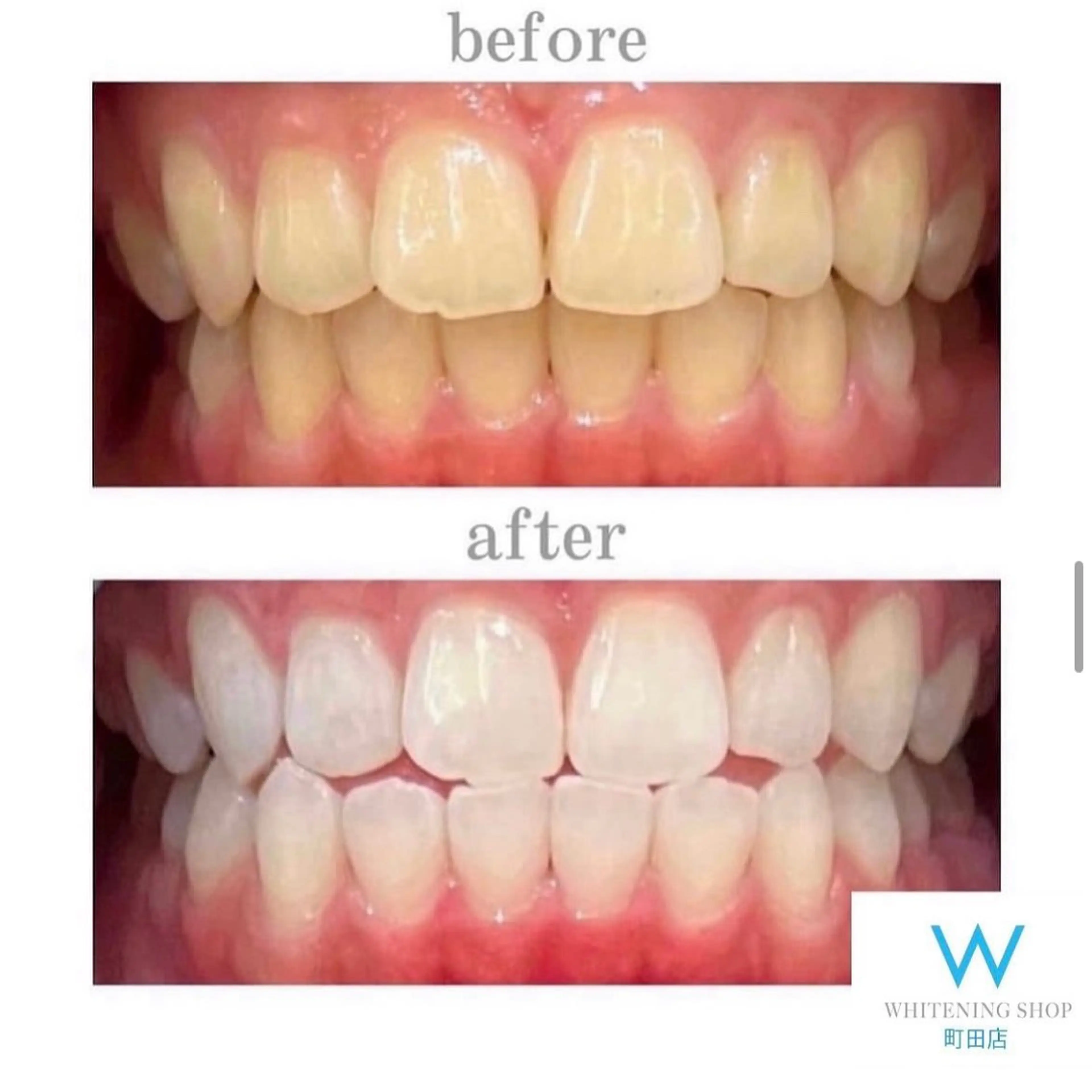 【ミニモ限定メニュー】セルフホワイトニング1セット（40分）¥8980→¥2000※口コミ条件の写真