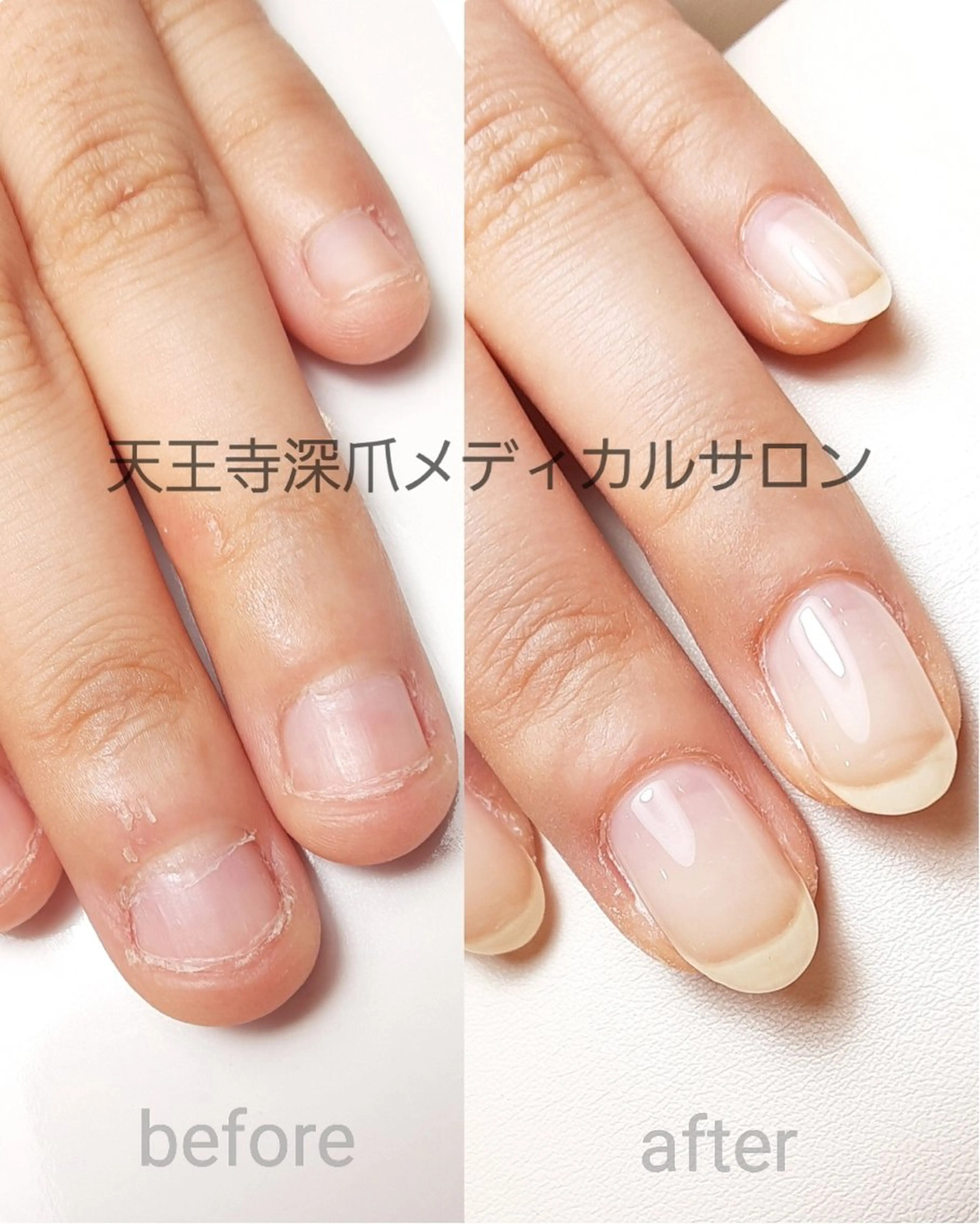 ネイル 天王寺 深爪メディカルサロンのネイルデザイン