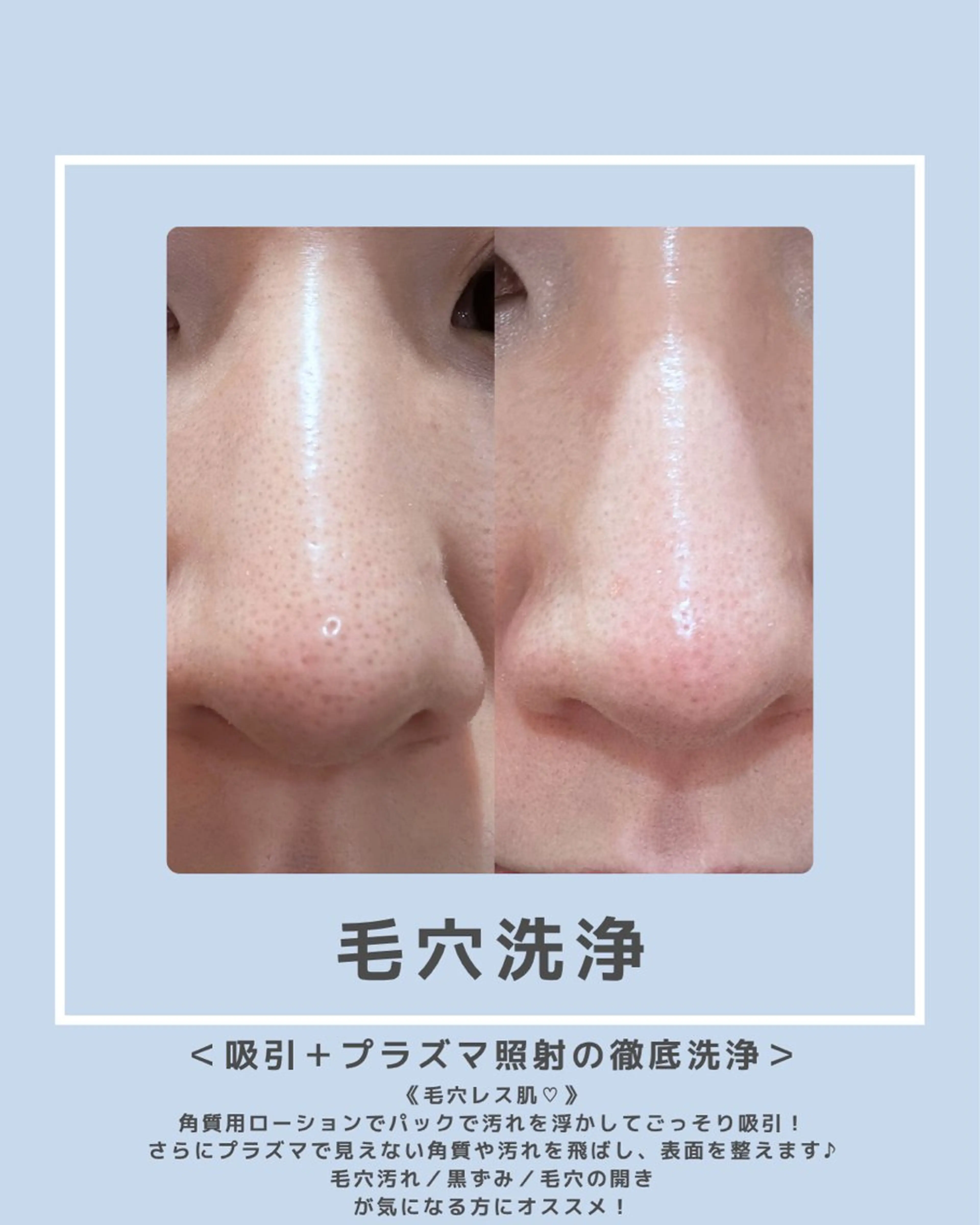 |ピーリング・毛穴| soina神楽坂のエステ・リラクイメージ