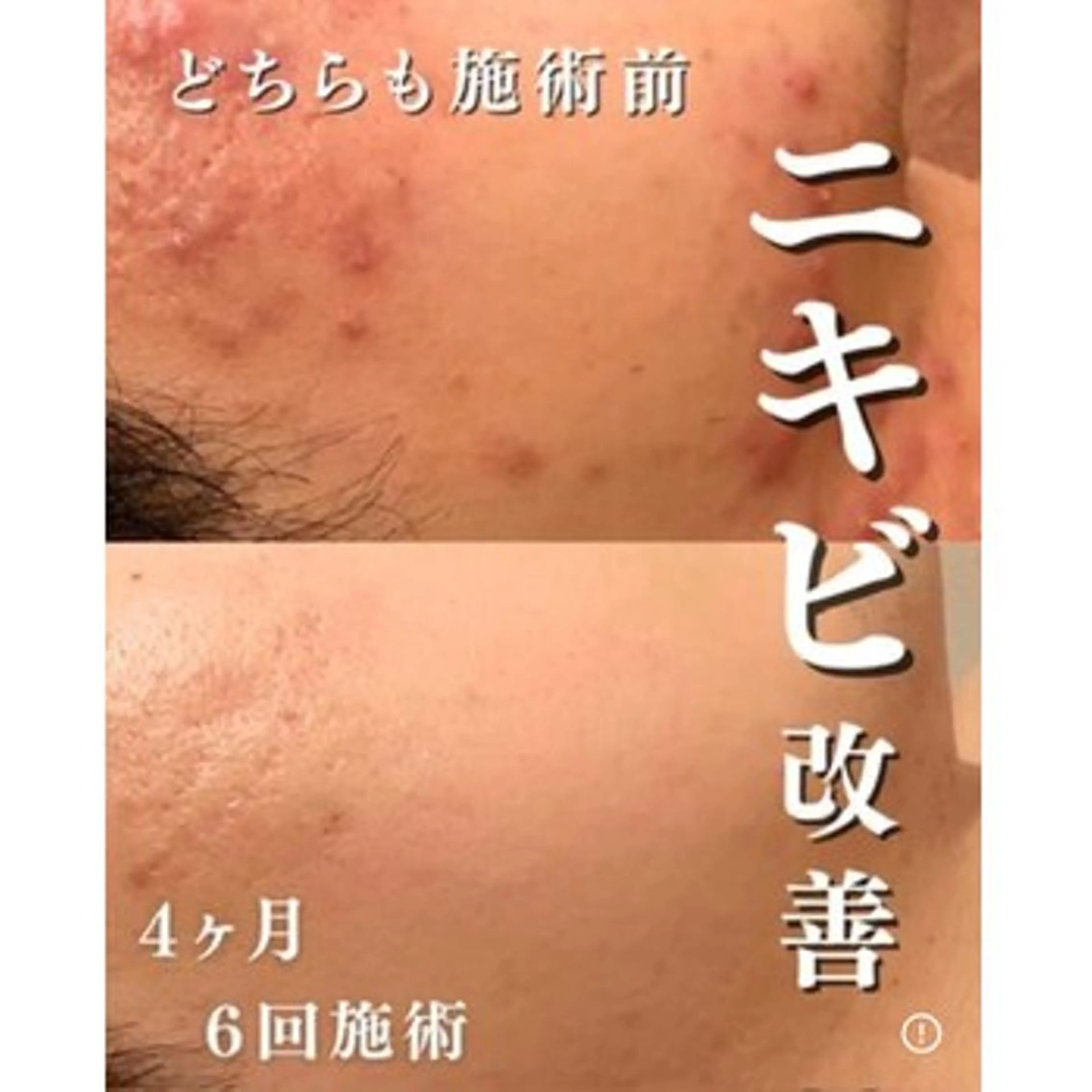 3か月で肌革命👼 ニキビ専門店💫のエステ・リラクイメージ