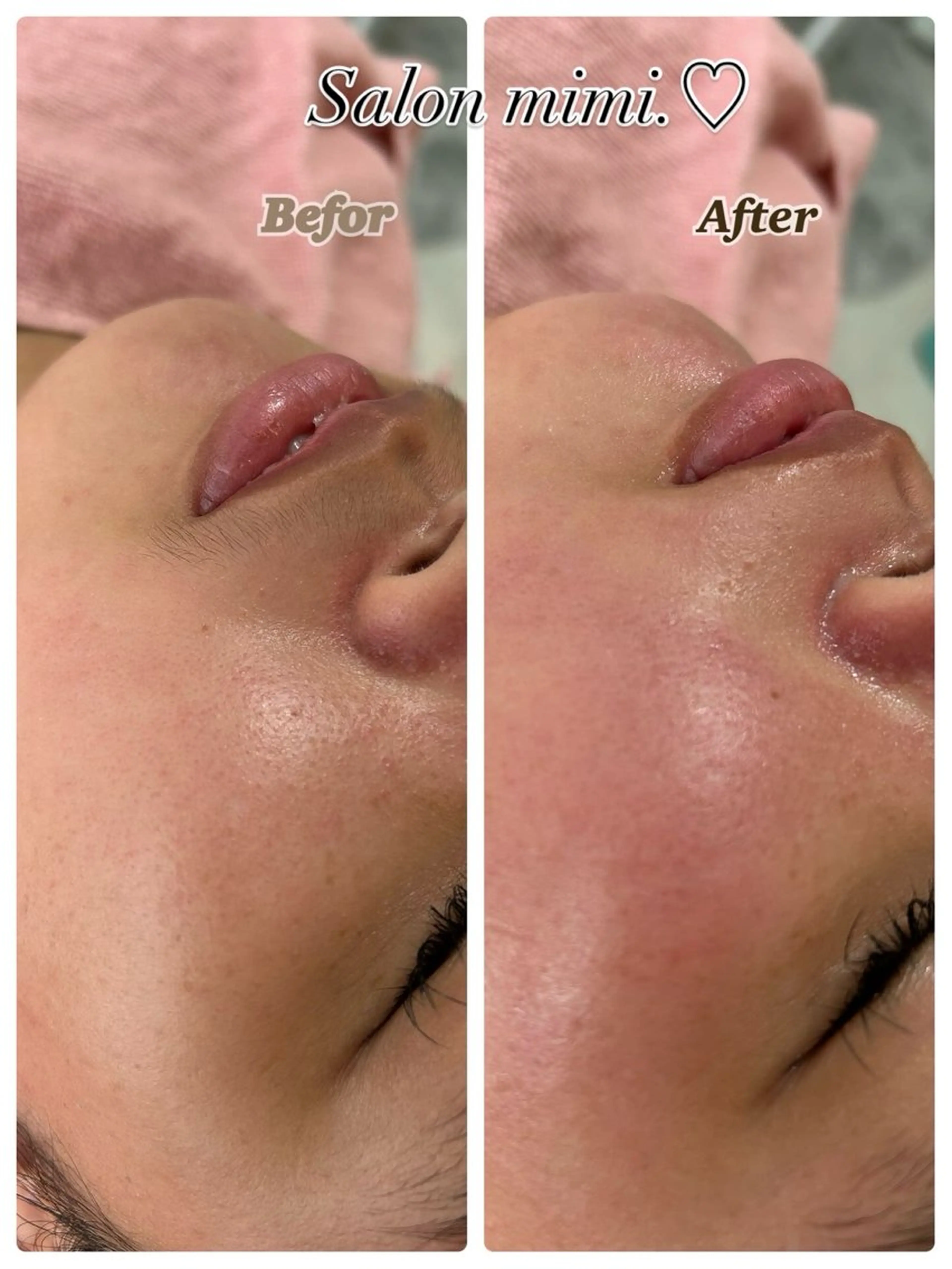 脱毛 mimi.♡ MINA.のエステ・リラクイメージ