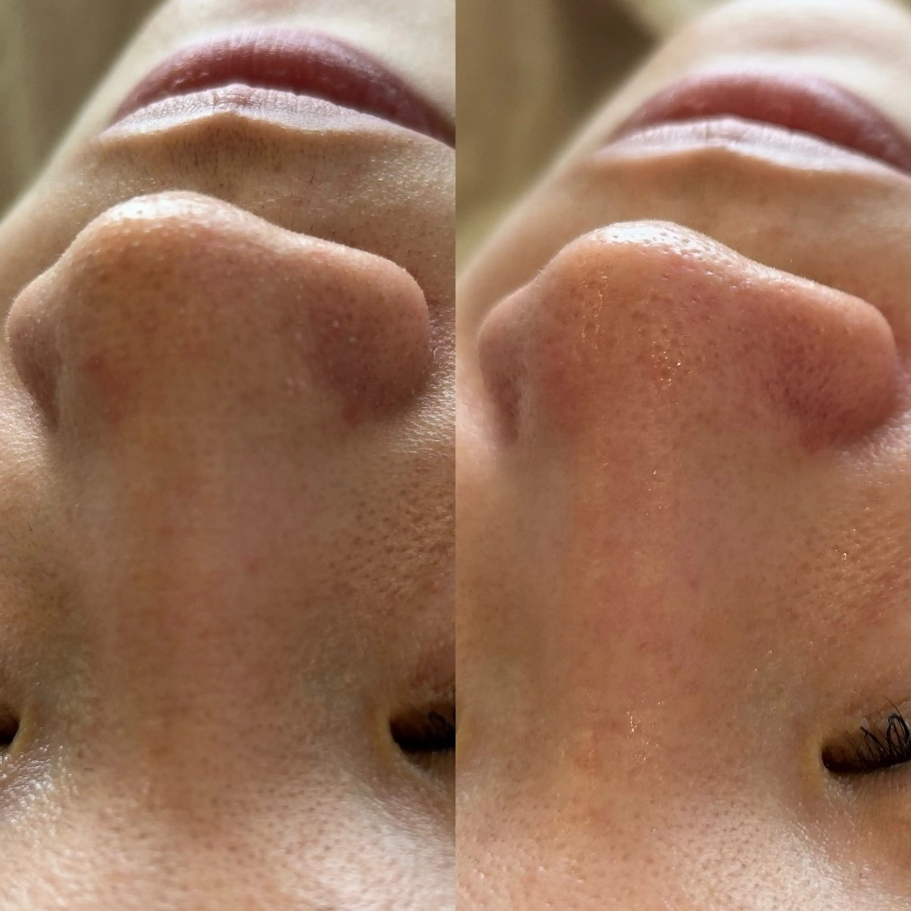 毛穴洗浄で毛穴の黒ずみ解消の写真