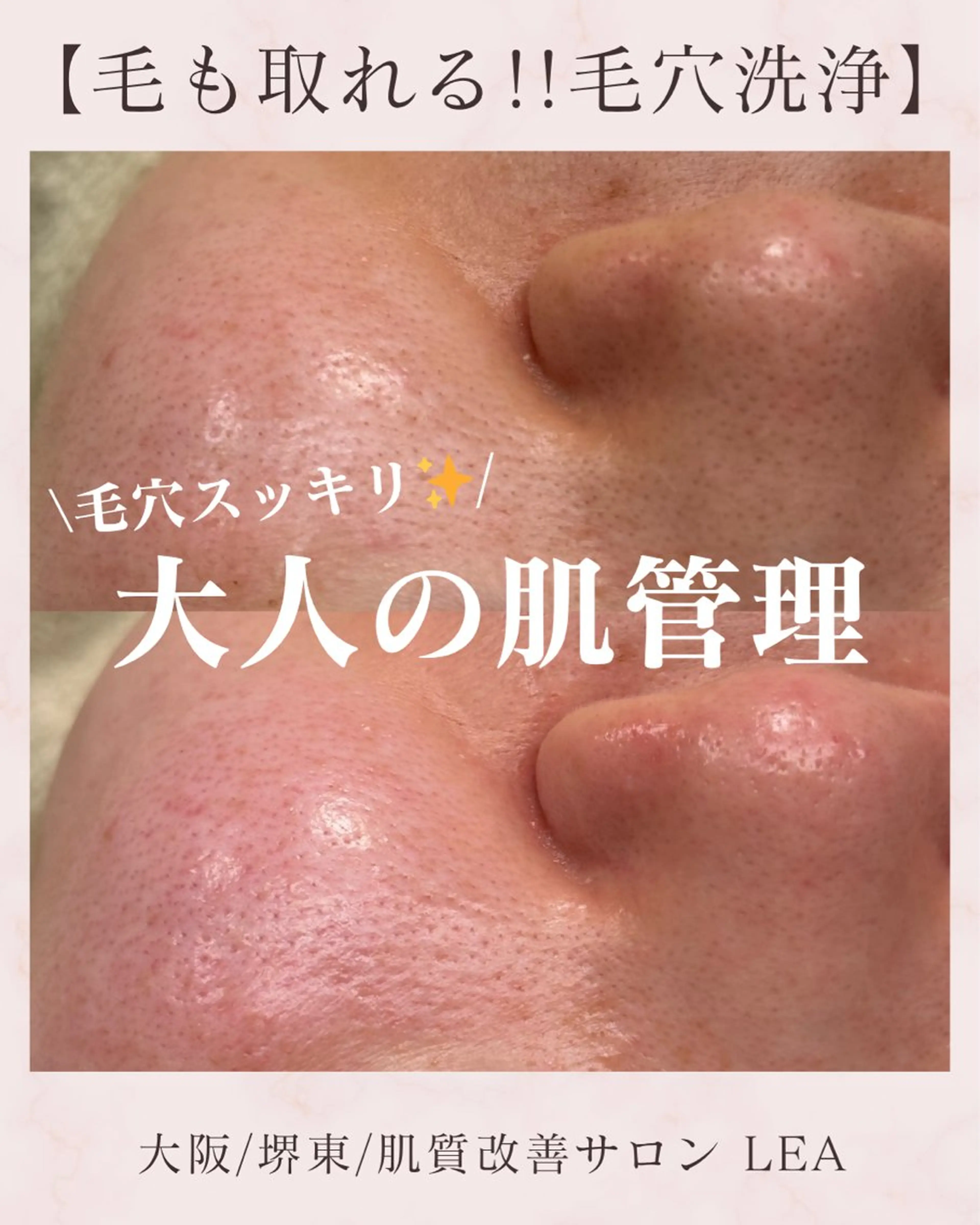 エステ Lea堺東　毛穴洗浄 ×顔ワックス脱毛のその他イメージ