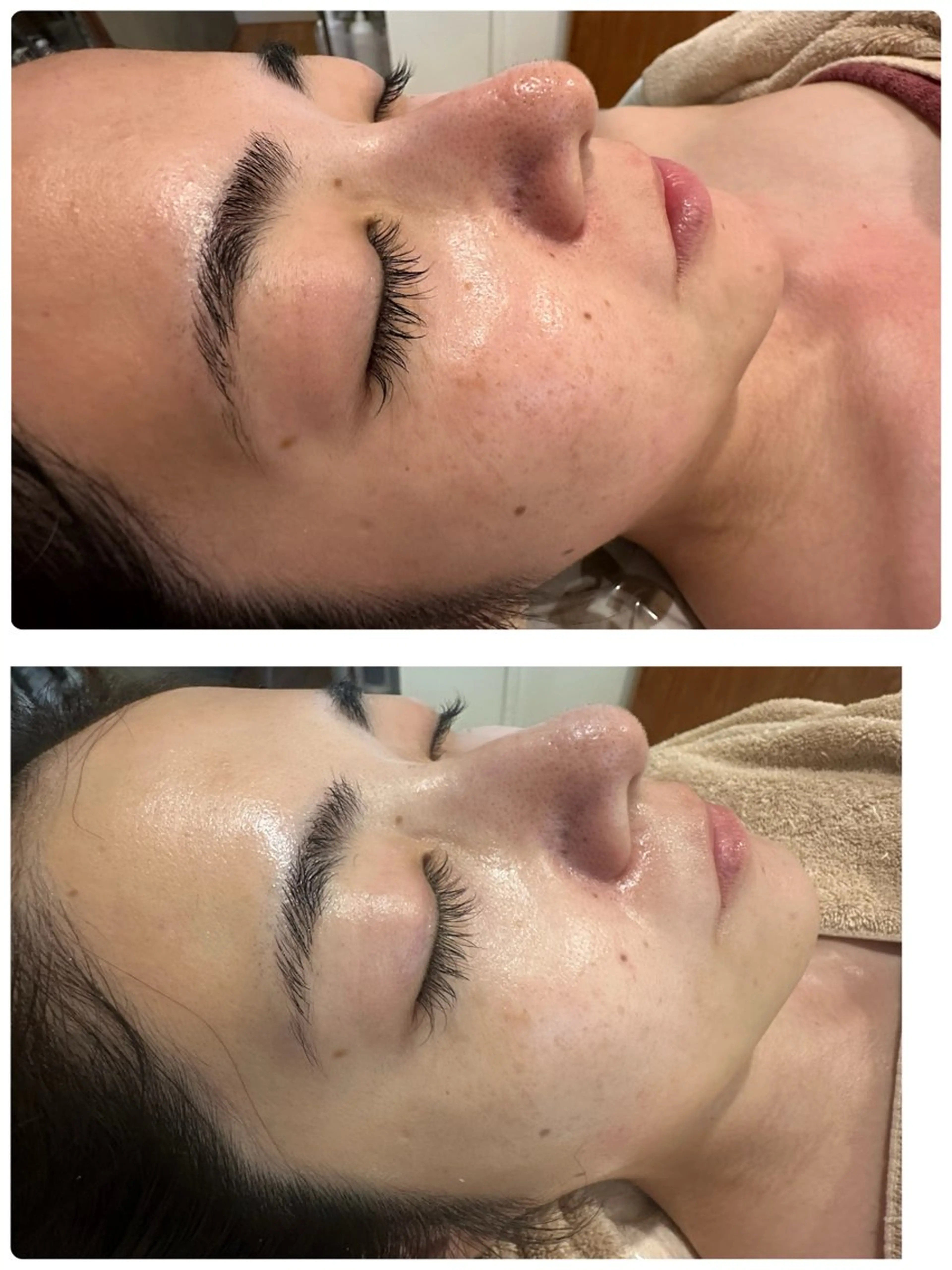 エステ つるんとむき卵肌に 🌟ハーブピーリングのエステ・リラクイメージ