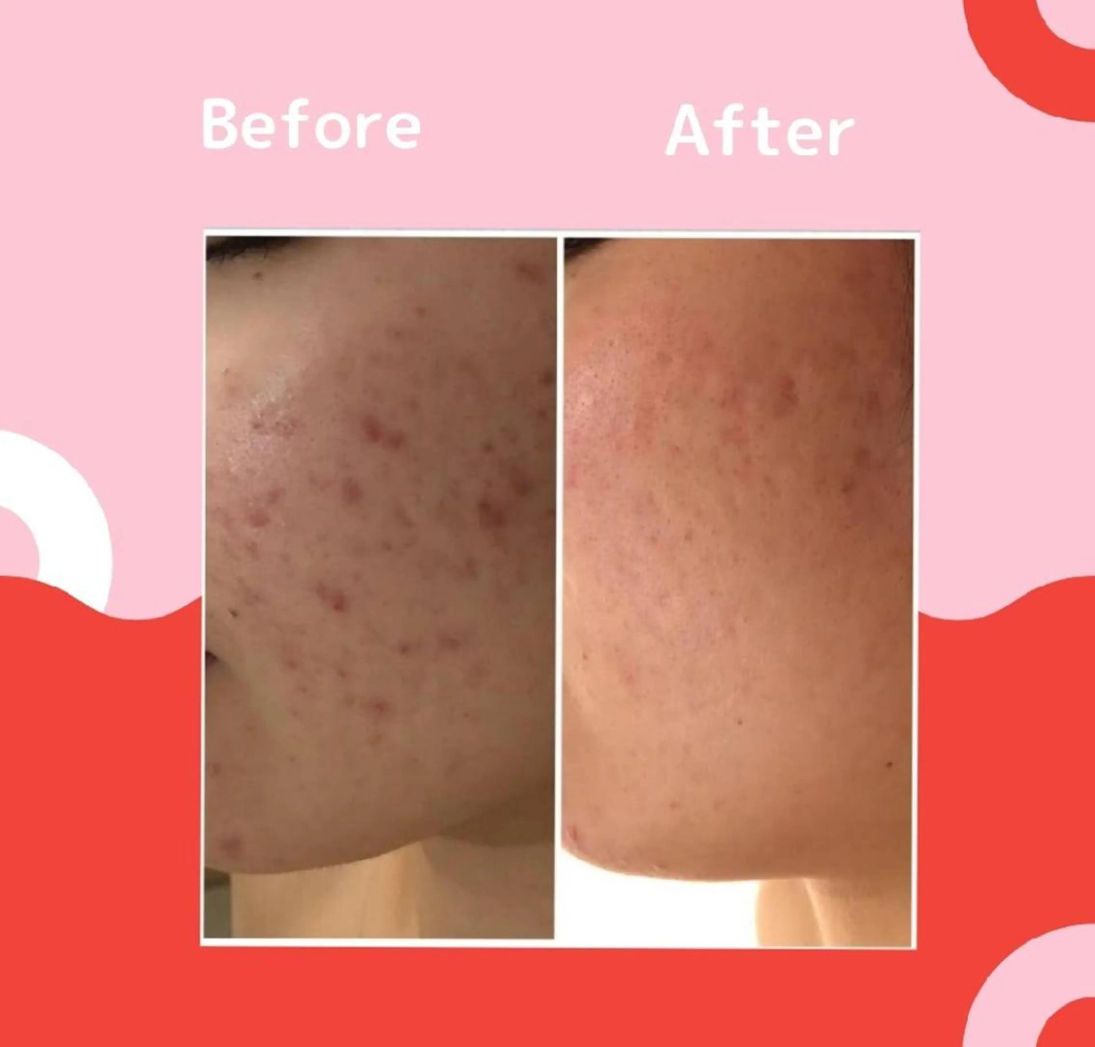 3か月で肌革命👼 ニキビ専門店💫のエステ・リラクイメージ