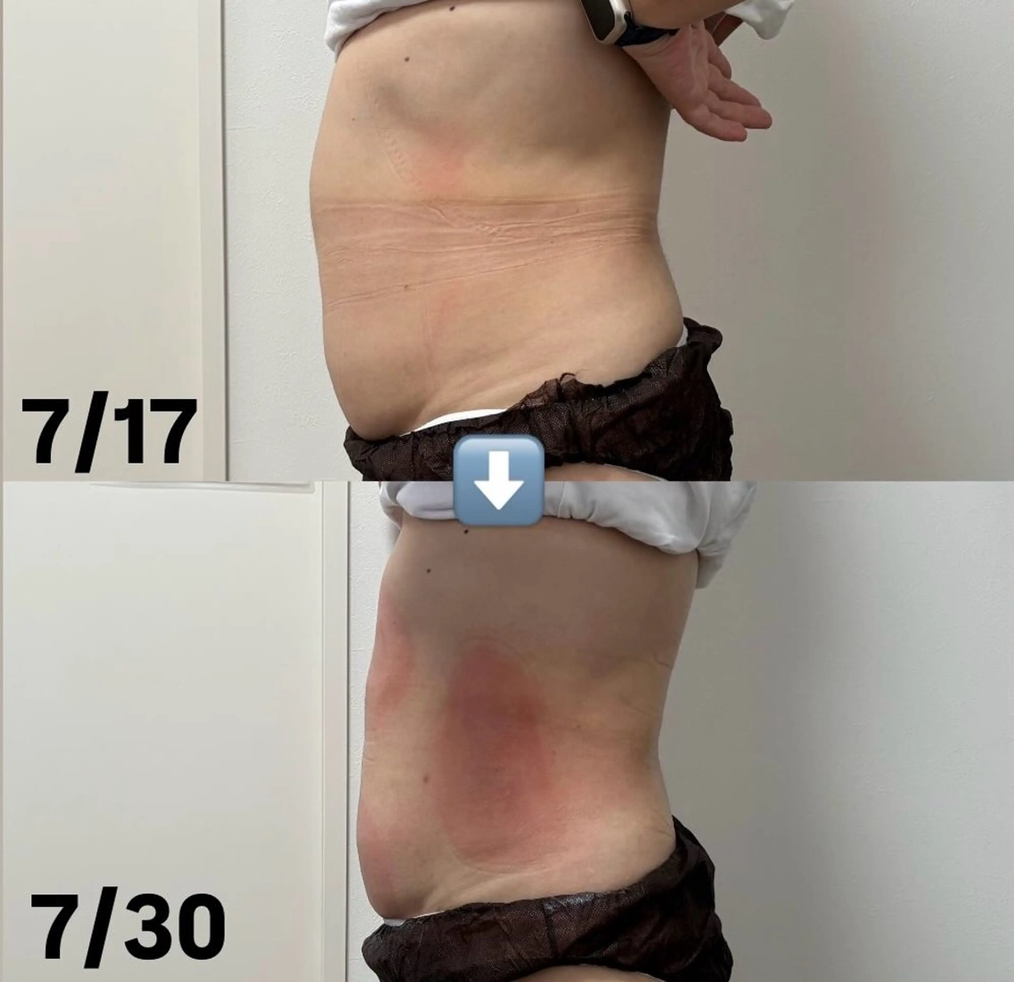 初回 お好きな箇所4カップ(お腹腰周り、背中、太もも周りを早くサイズダウンしたい方におすすめ)の写真