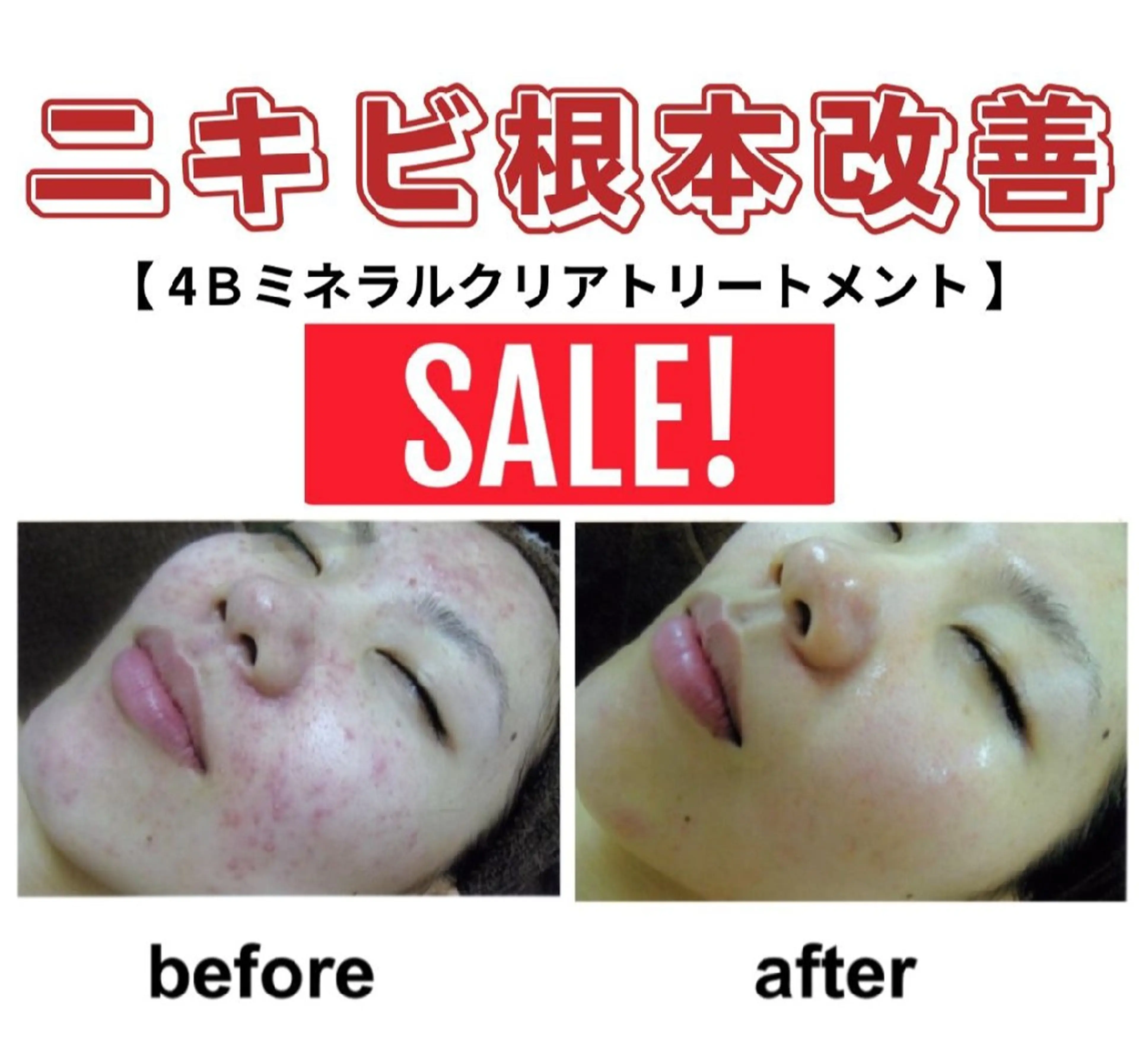 肌質根本改善❤ハーブピーリングの写真