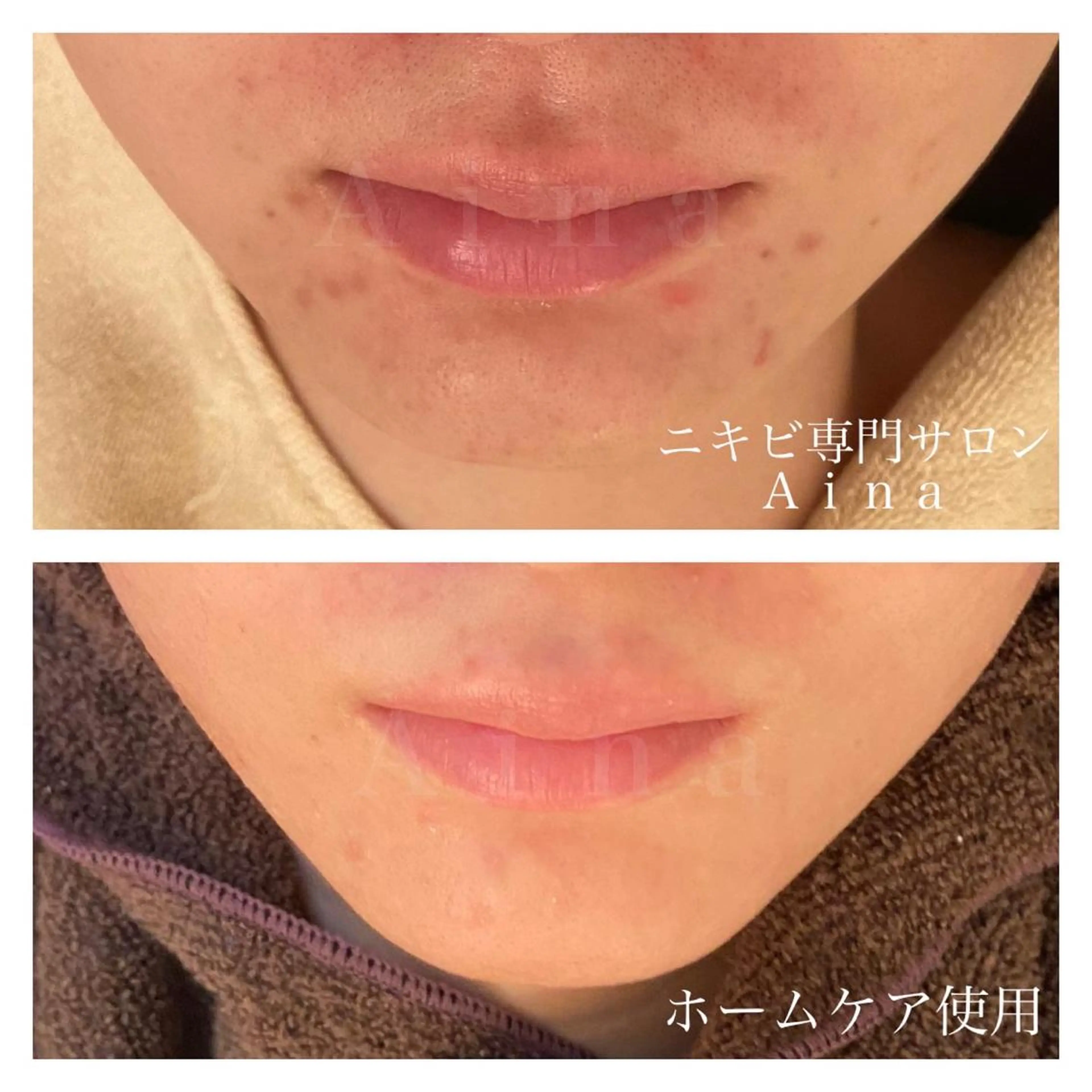 セミロング パーマ ヘアアレンジ メンズ キッズ ネイル マツエク・マツパ 学生(メンズ向け) 学生 エステ リラク ニキビ跡専門サロン Ainaのエステ・リラクイメージ