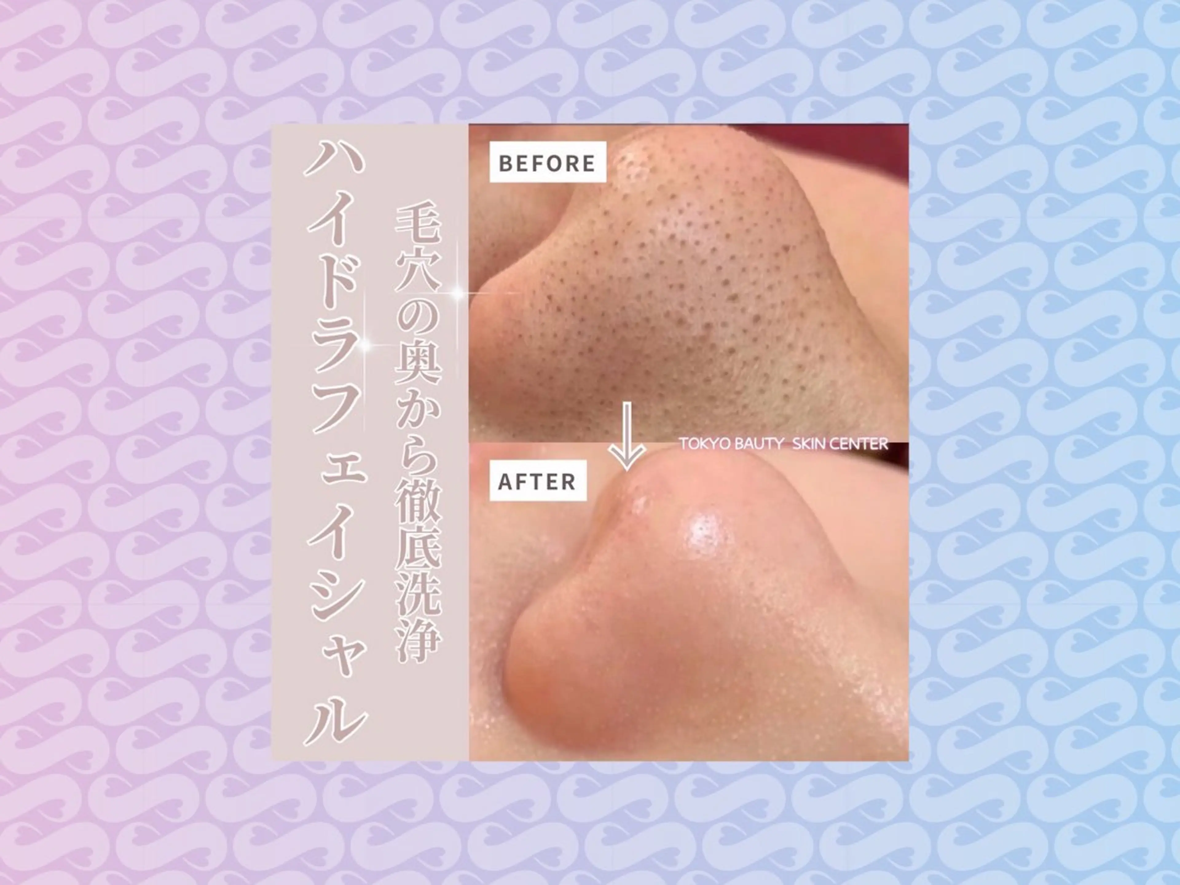 エステ リラク 毛穴洗浄& 睫毛パーマ上野御徒町のマツエク・マツパデザイン