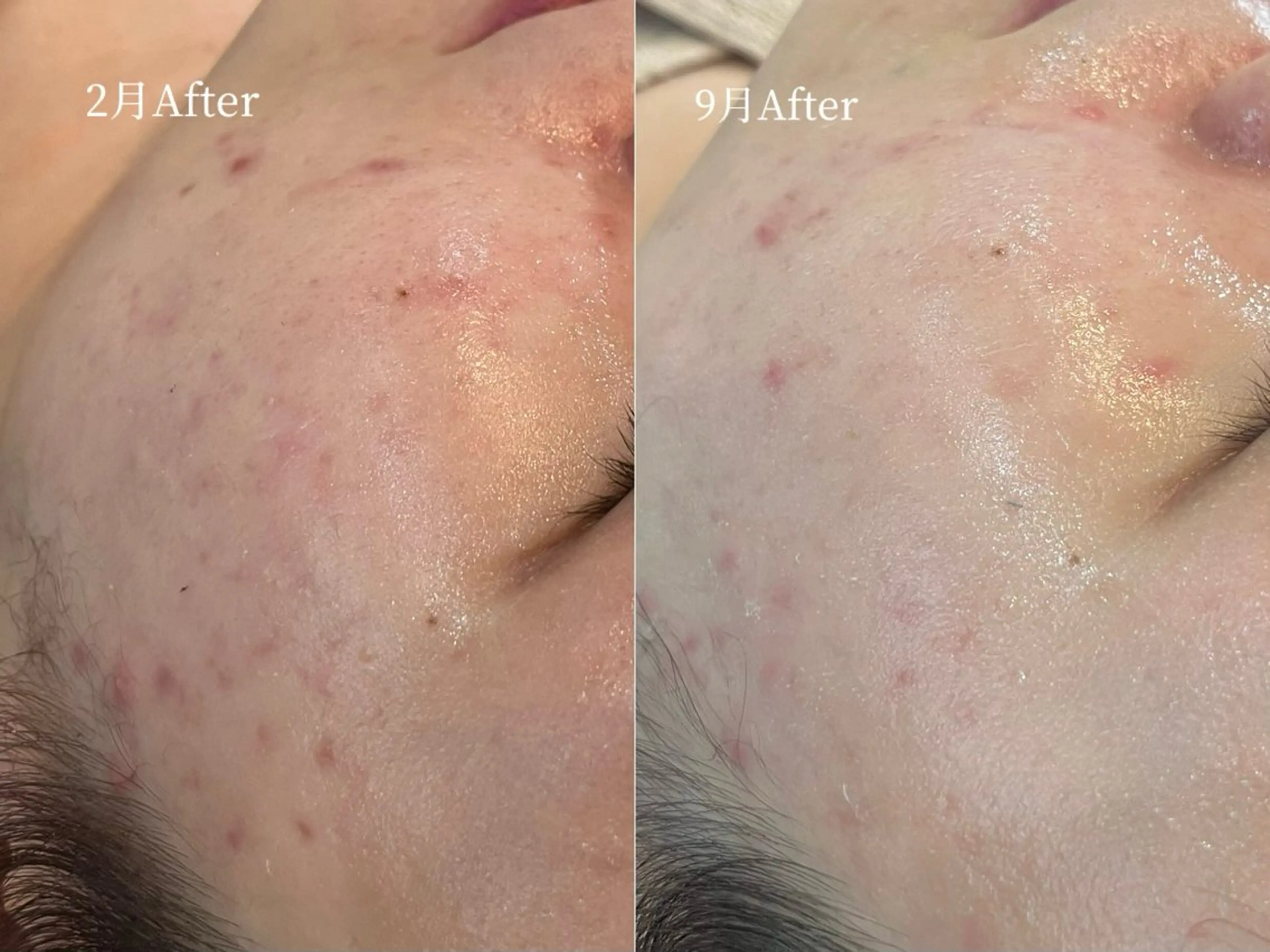 エステ yc.hacci 【ハーブピーリング】の眉毛・アイブロウイメージ