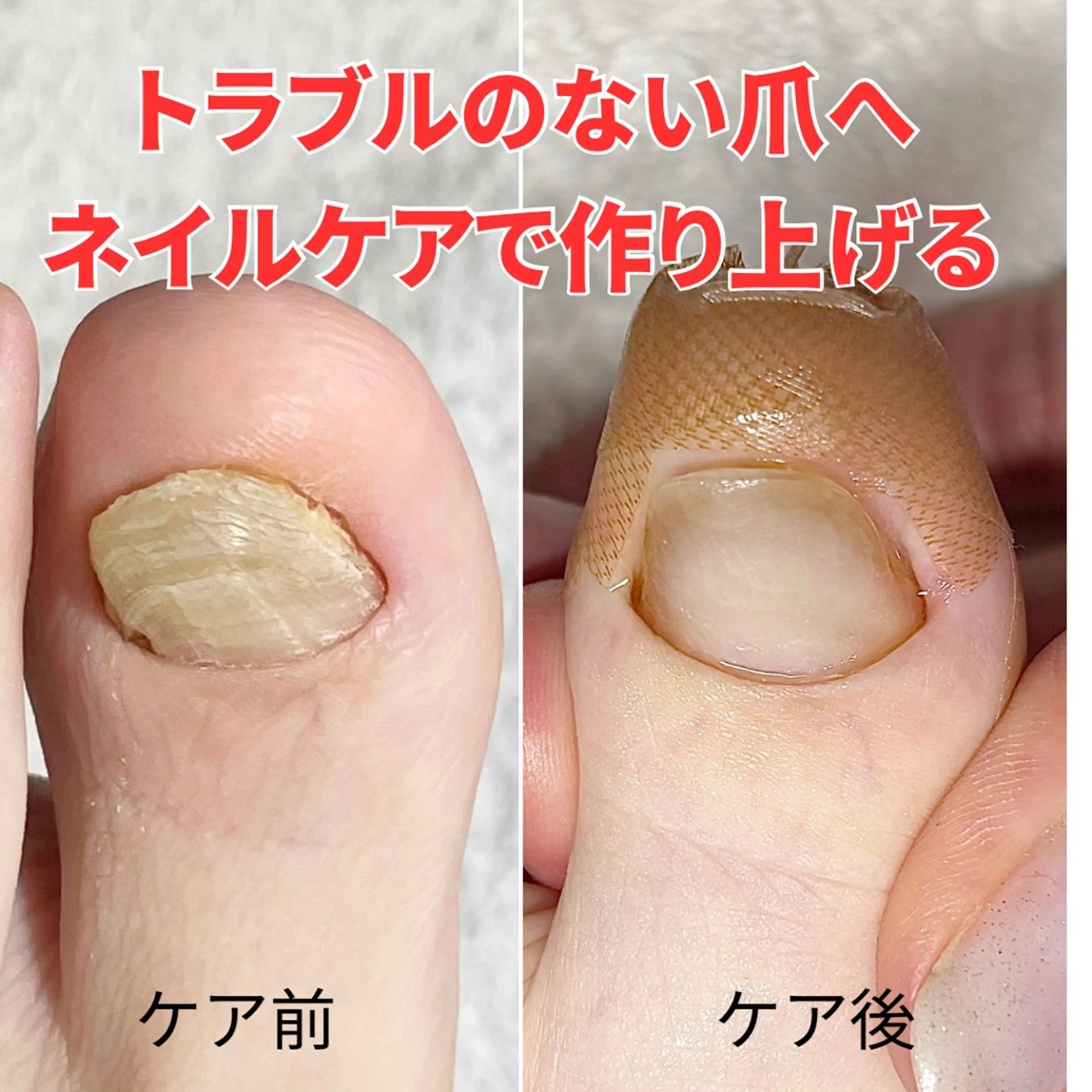 ネイル 深爪・巻き爪 専門サンセリテのネイルデザイン