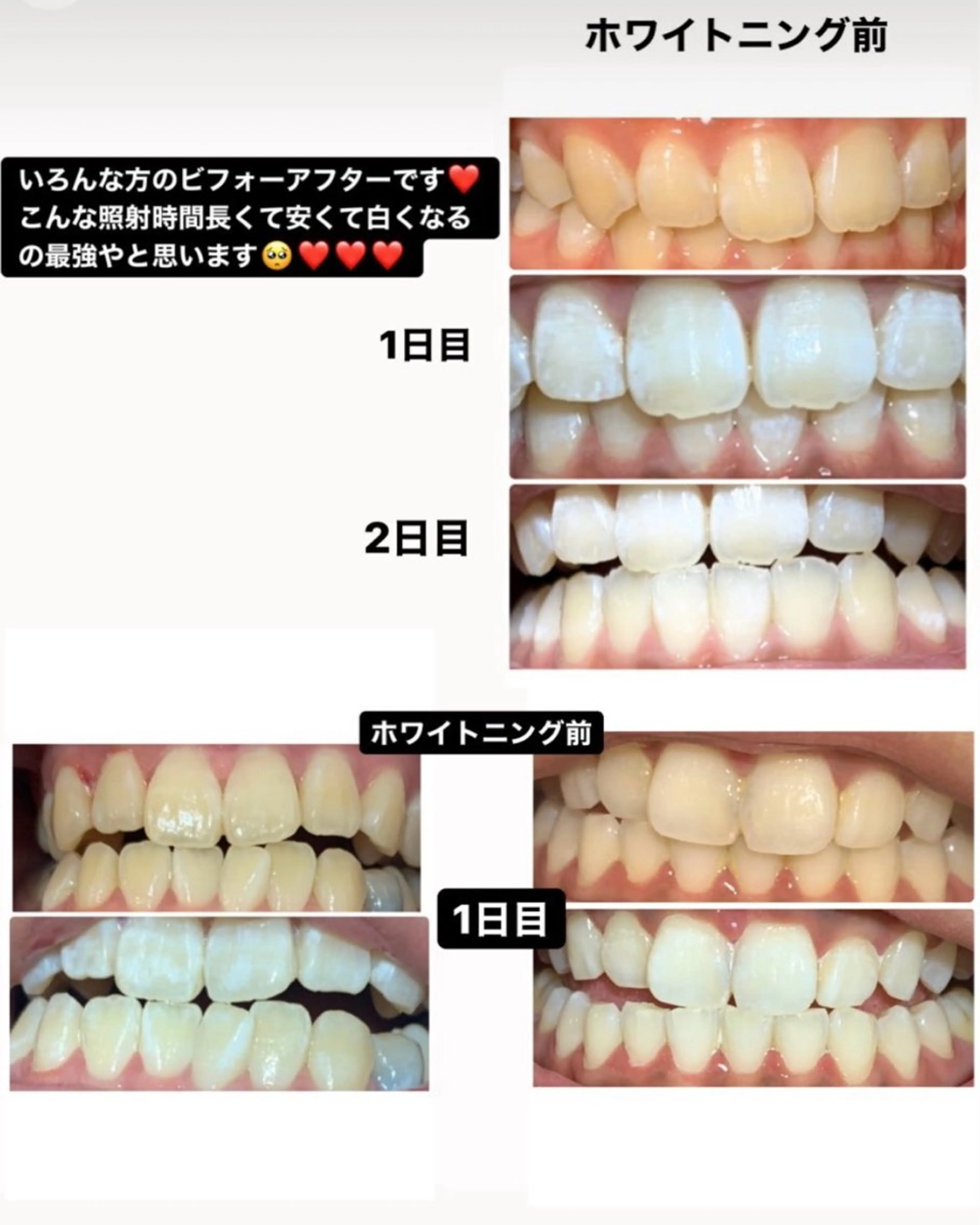 ホワイトニング＆耳ツボ🤍🪽　【有名モデル様ご来店】💕"(🉐なsetメニュー)の写真