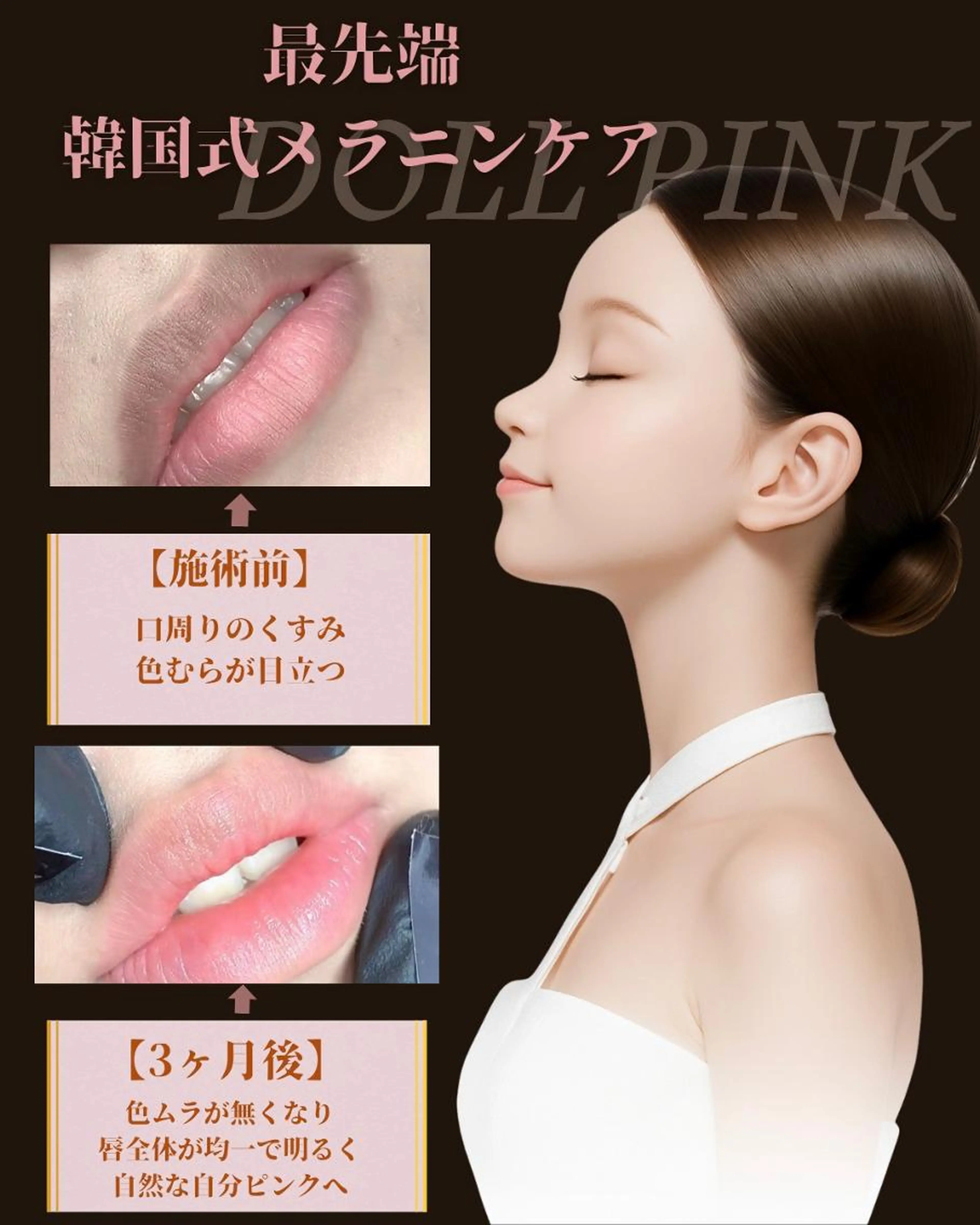 【最先端韓国式メラニンケア】 ドールピンク《乳輪/乳頭》￥32,000の写真