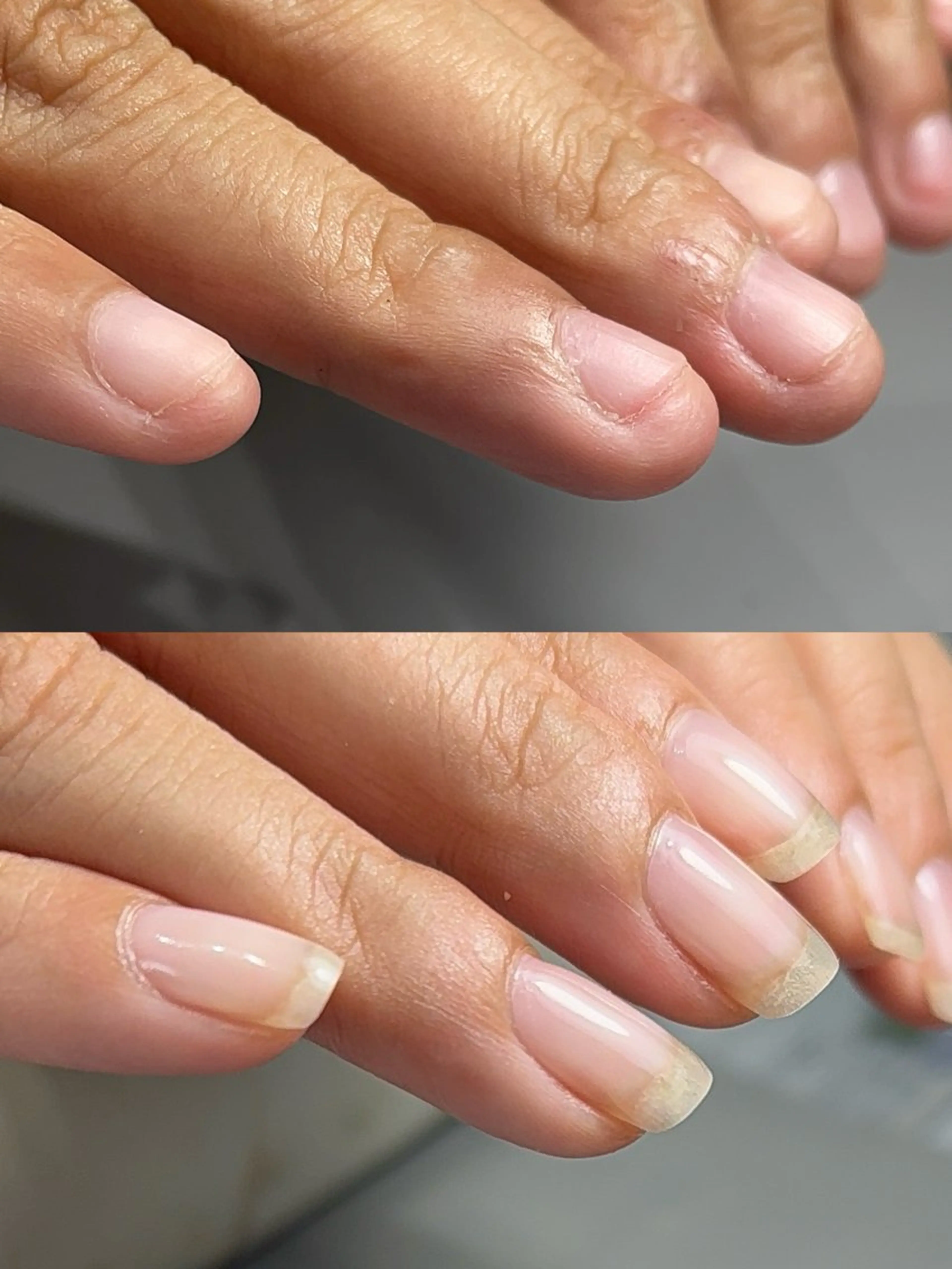 もう隠さない！深爪緩和で新しい自分へ𓂃𓂂の写真