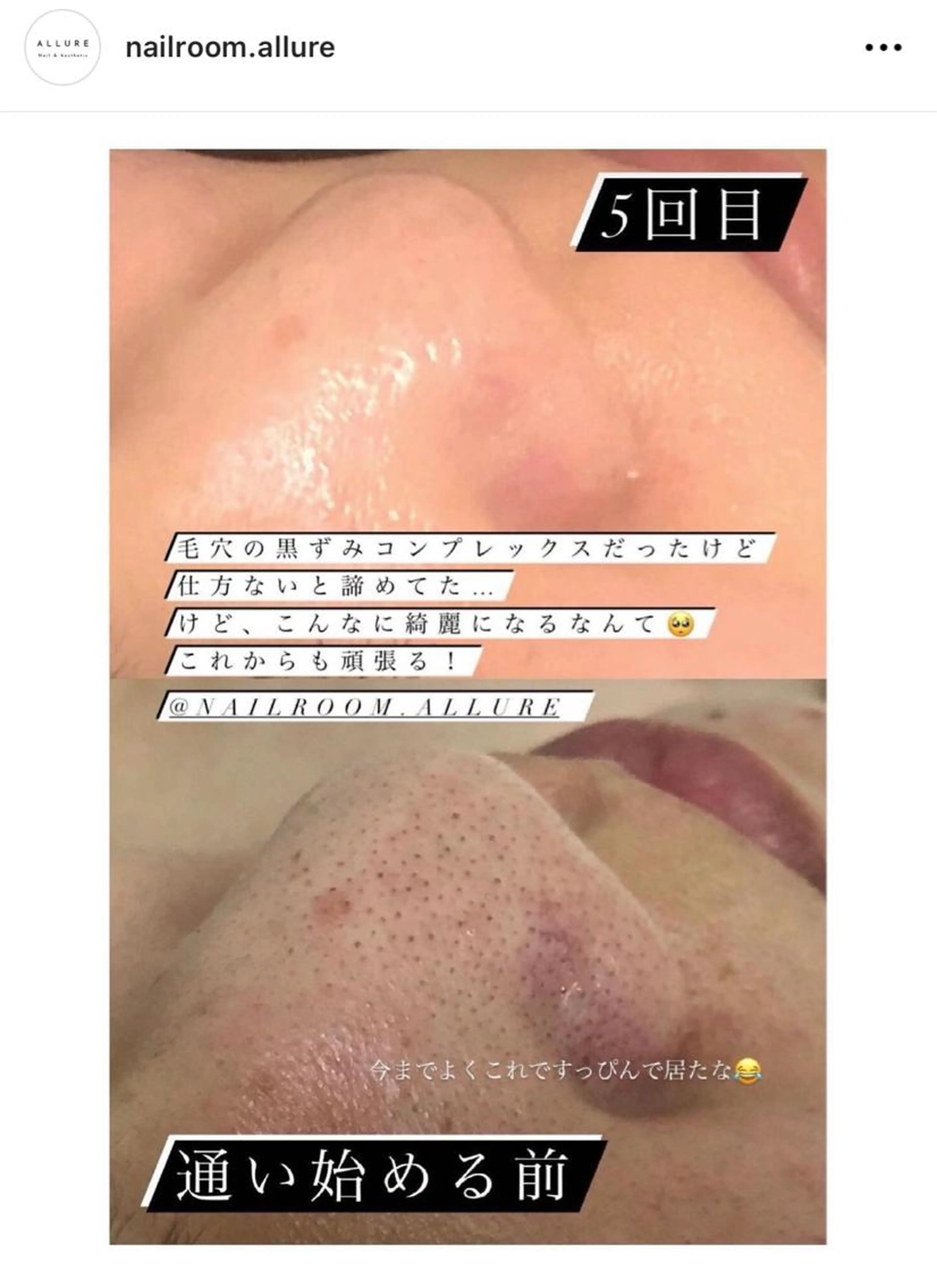 痛くない毛穴洗浄フェイシャル！黒ずみ、開き毛穴、イチゴ鼻でお悩みの方！！都内美容クリニックの施術を柏崎で受けられますの写真