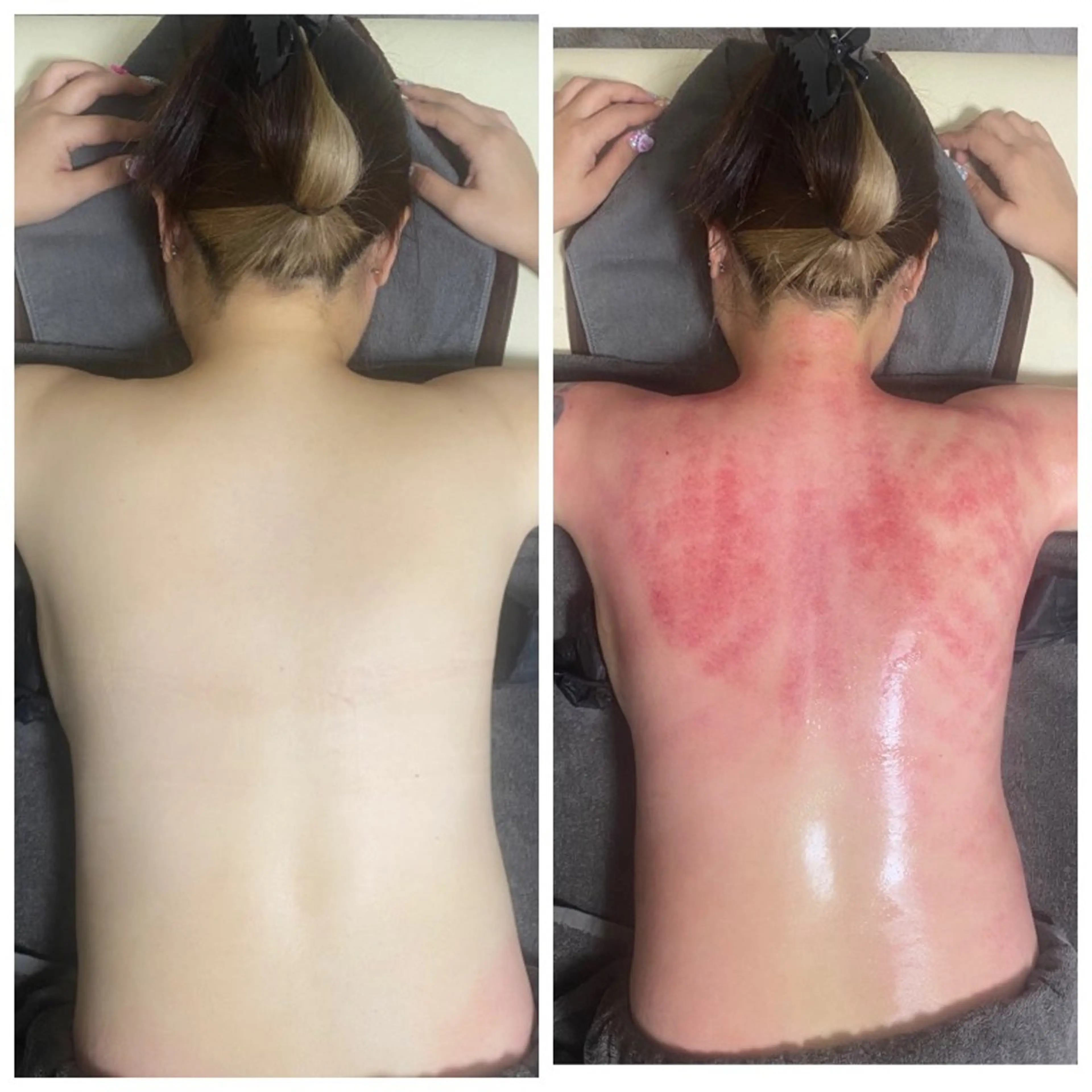 カッピング痩身 上半身25分の写真