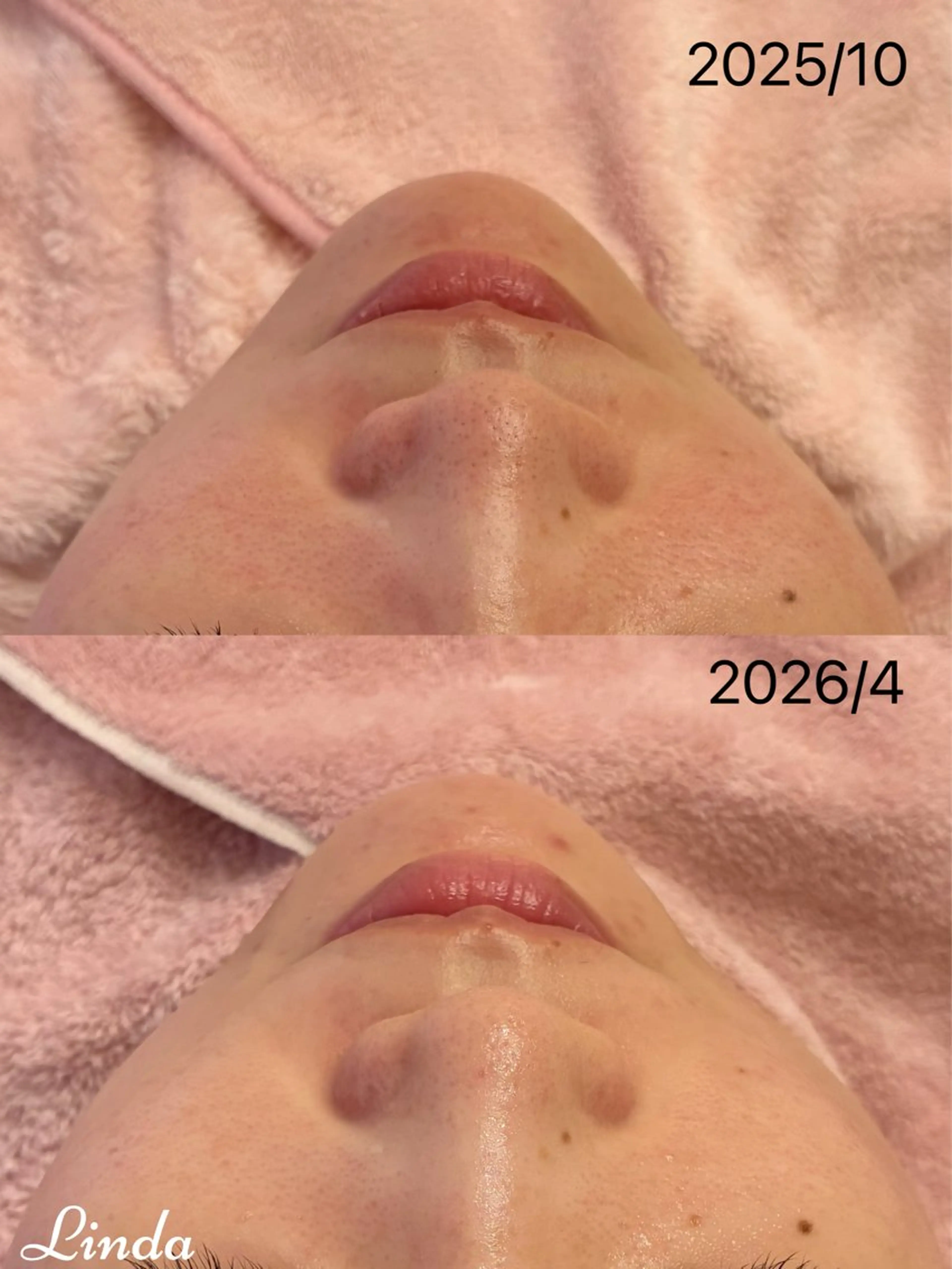 エステ 小顔&毛穴・肌質改善 LINDA西宮 AIのその他イメージ