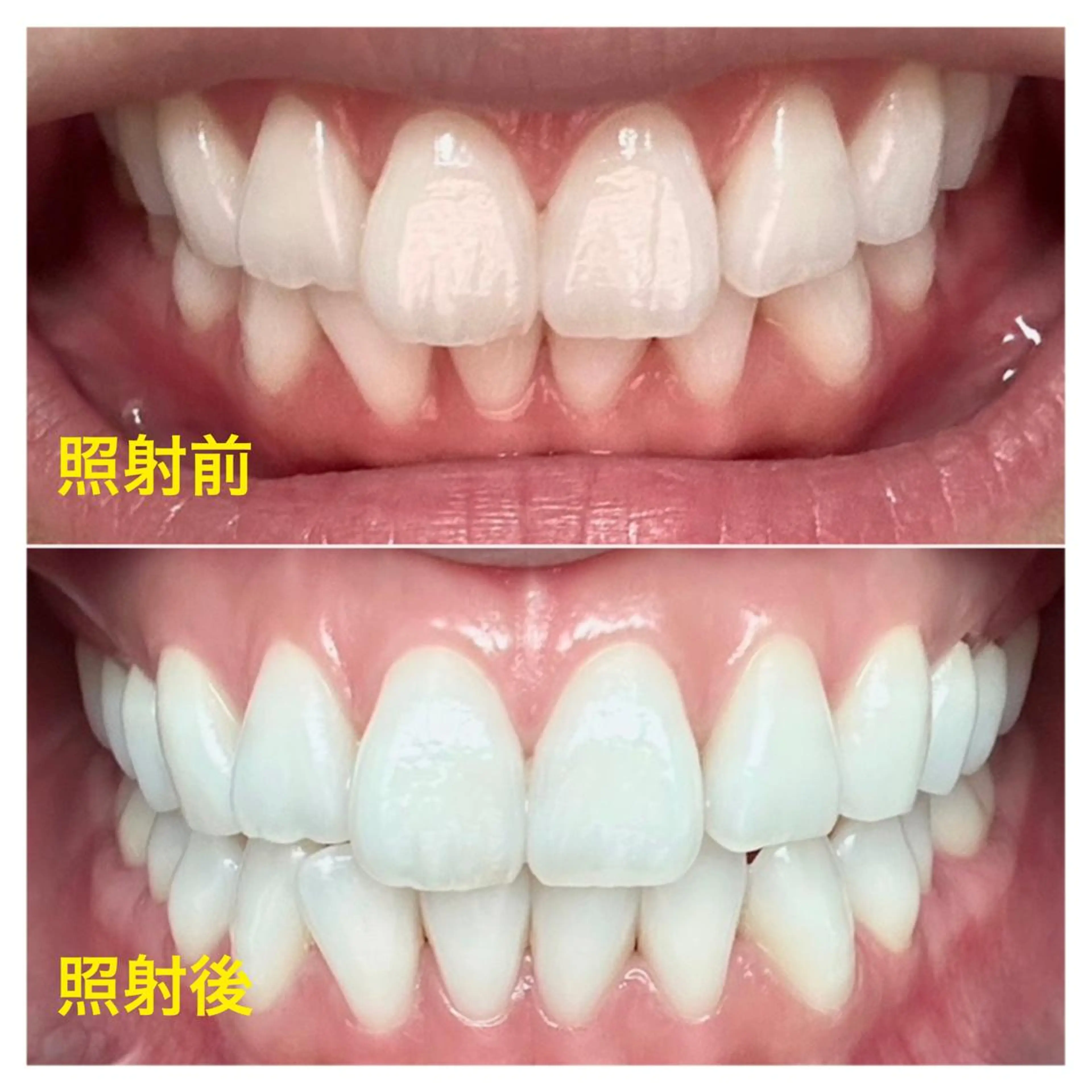 【大人気】ホワイトニング90分コース☆本気で歯を白くしたい方へ✨1日2名限定特別コース✨日本初‼️の写真