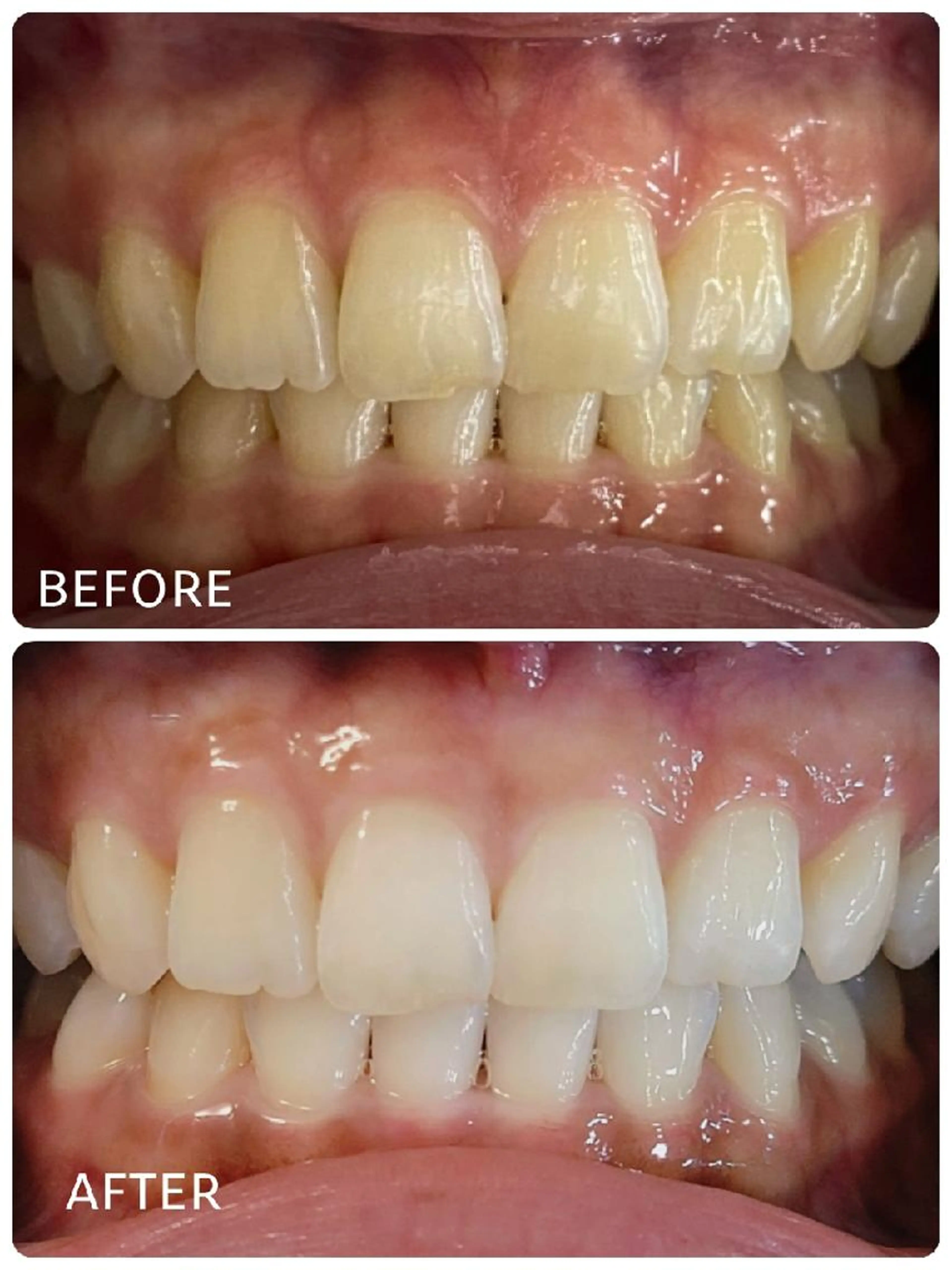 ホワイトニング🦷期間限定‼️お試し3回コース🦷✨(現金払い)の写真