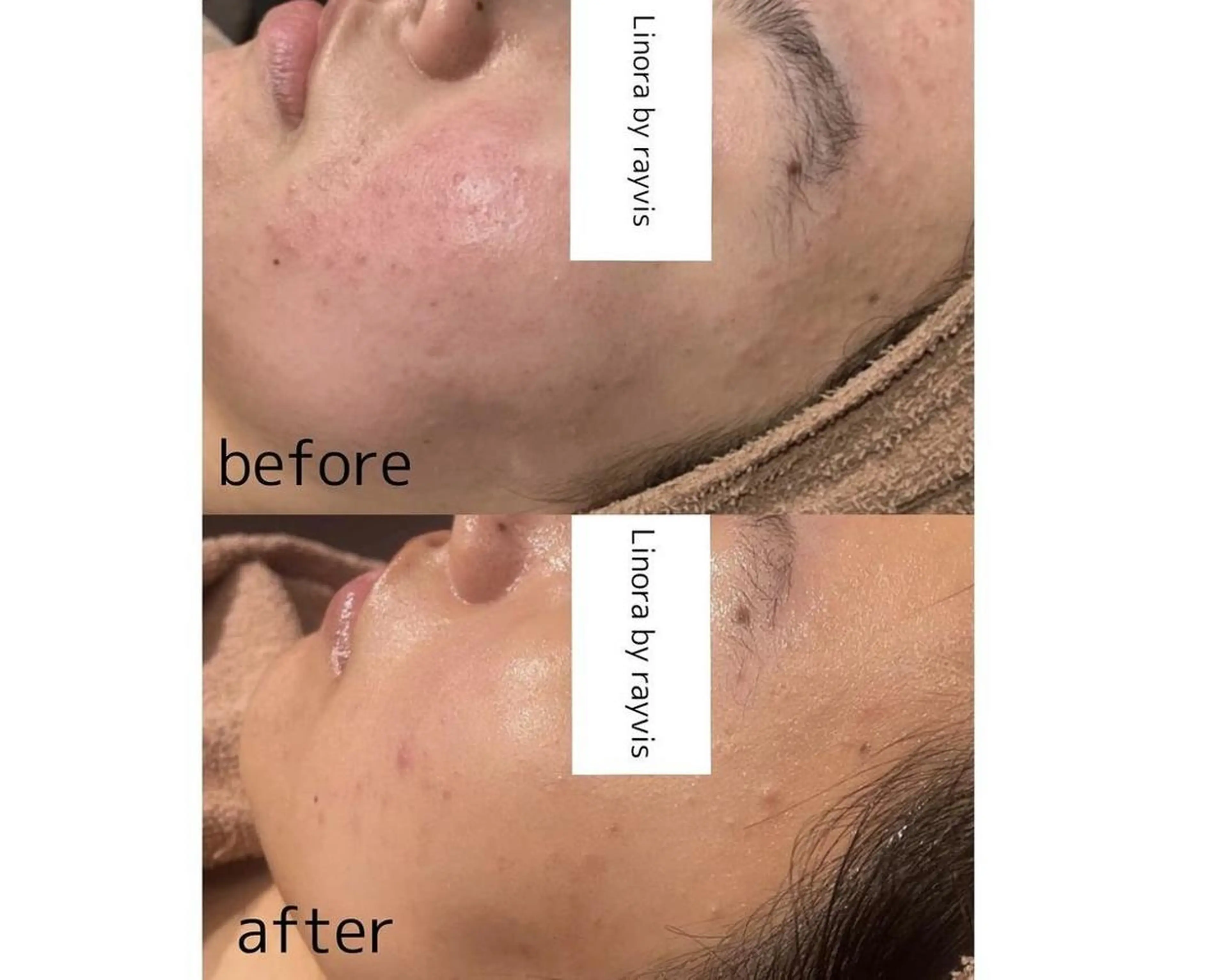 脱毛 🤍Linola🤍 レイビス 須藤のエステ・リラクイメージ