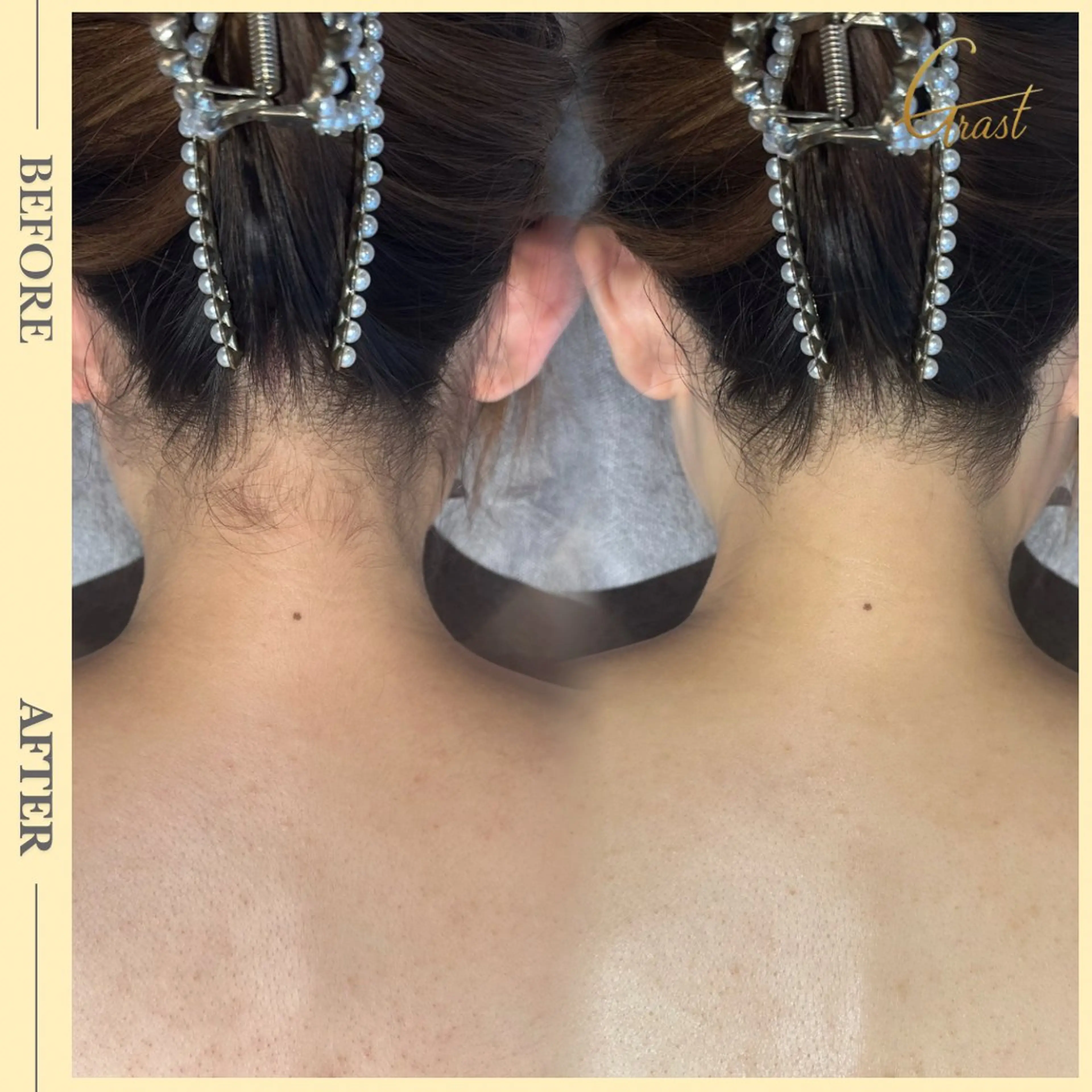 注目No.1★【背中うなじ脱毛】剃毛要らずでご来店◎初回体験→の写真