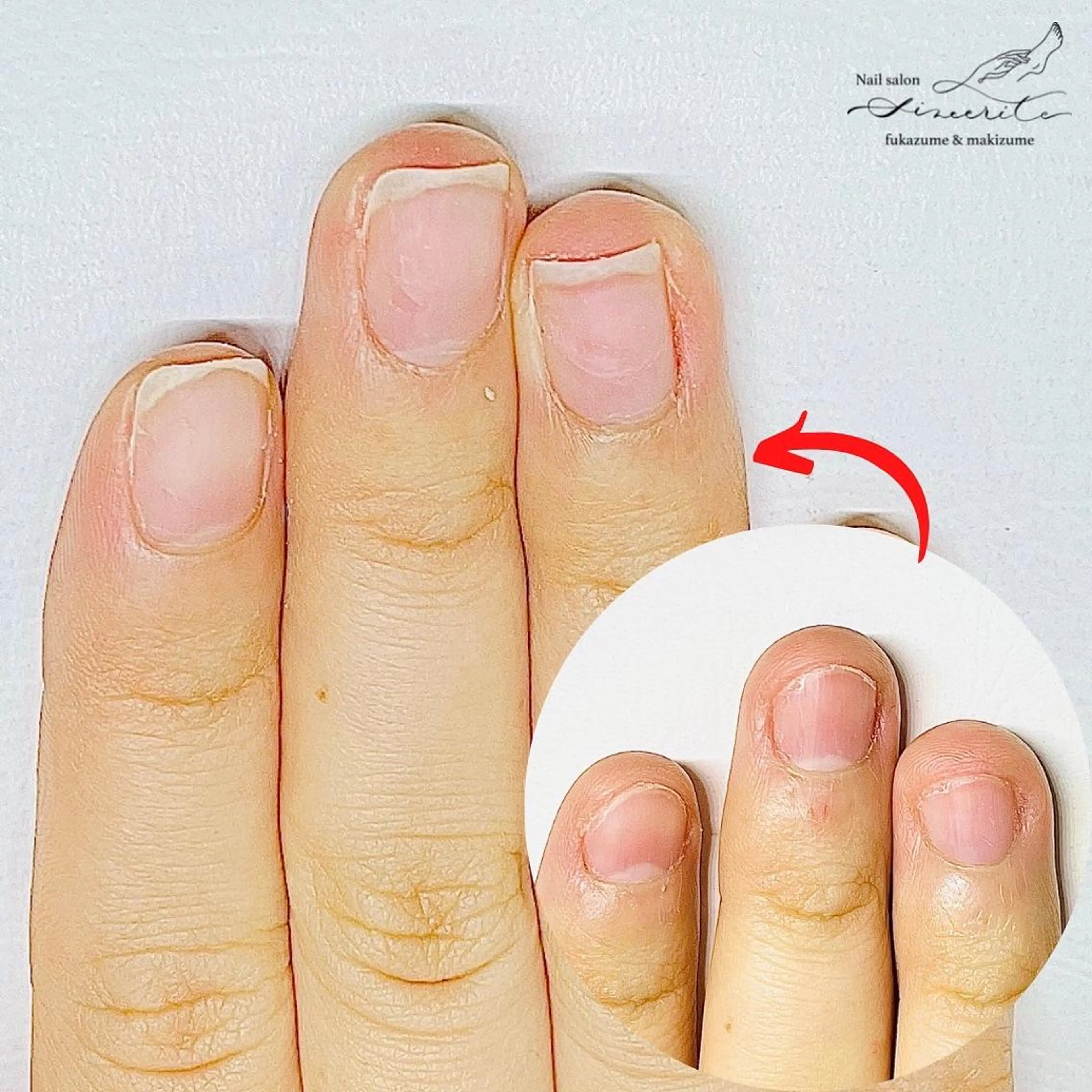 深爪集中ケア(2週間に1回来店×5回 来店期間3ヶ月)の写真