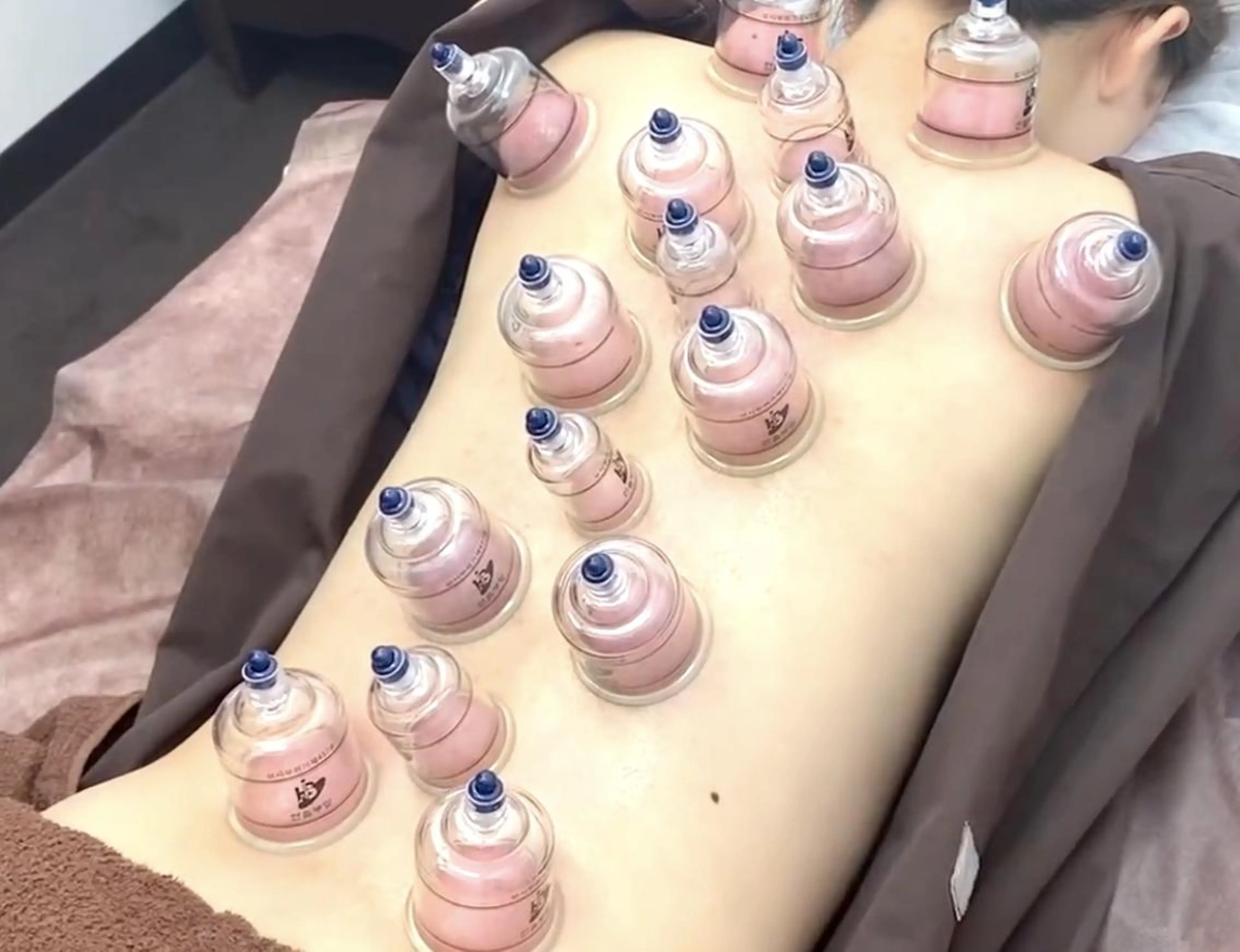 先着3名限定【慢性疲労/肩こり/腰痛】吸い玉+針90分⭐️針施術+カッピングの写真