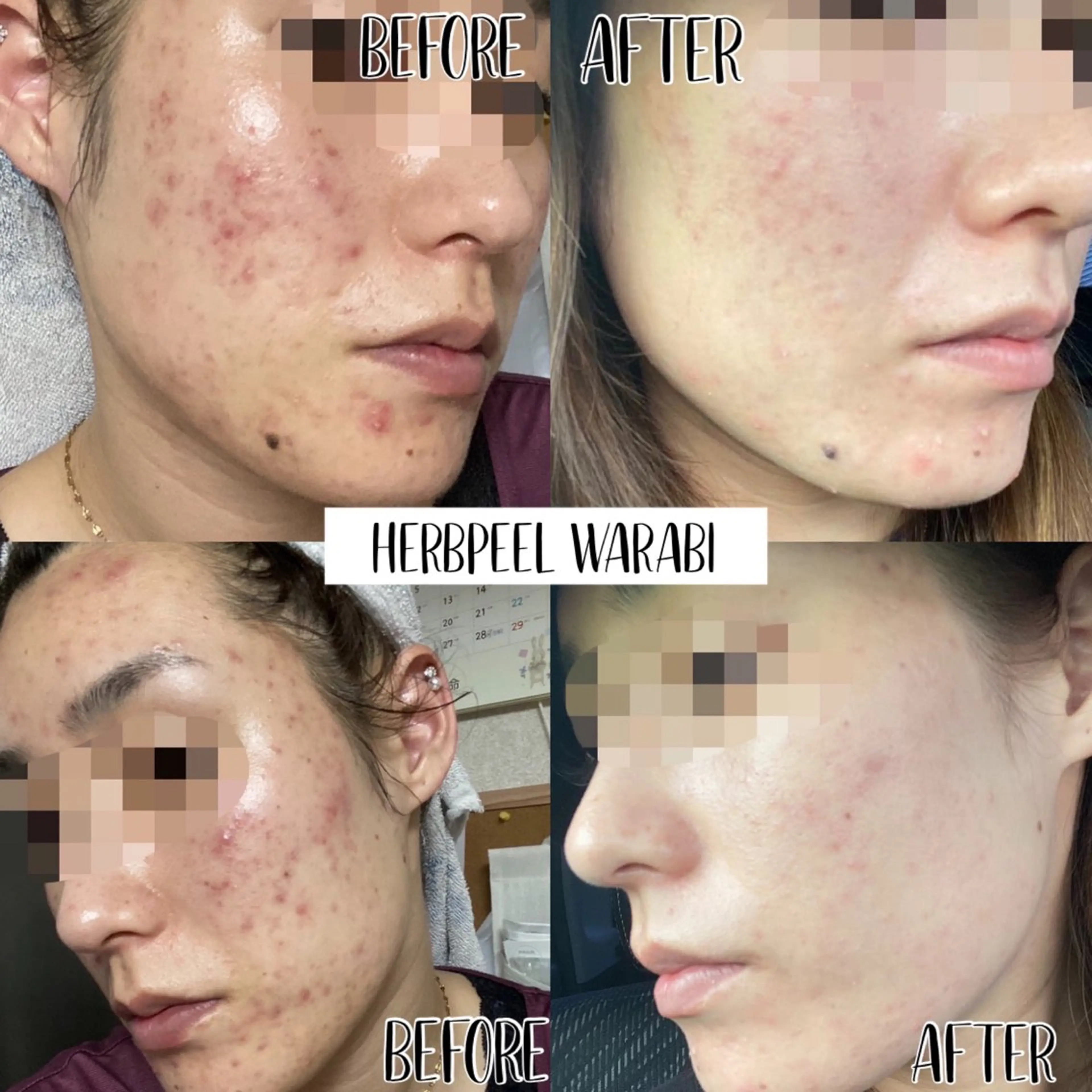 【諦めないで‼️もう繰り返さない最強ニキビケア🌿✨】REVI 🌹ハーブピーリング🌿ニキビ撲滅‼️集中改善コース🌿の写真