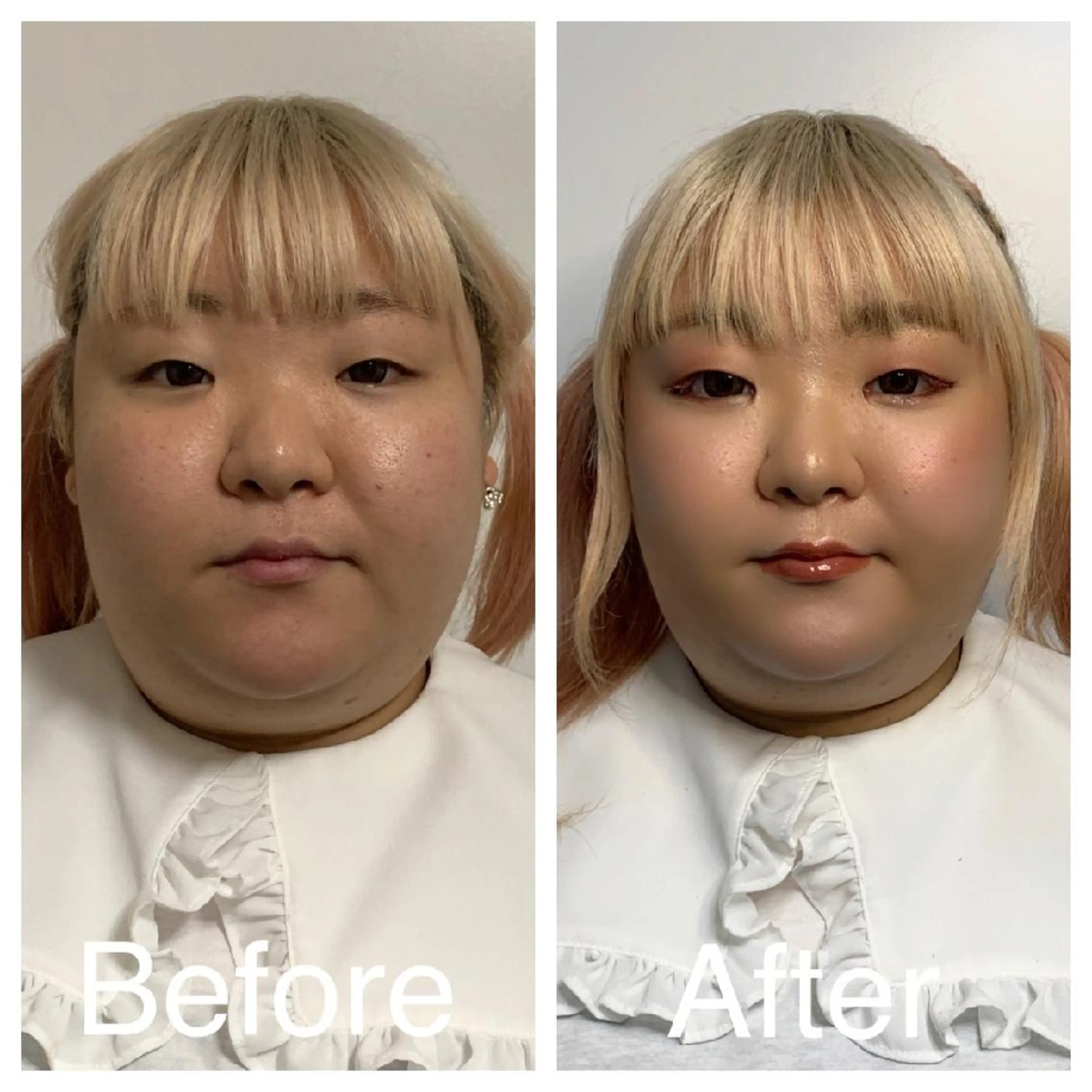 医療提携Ruby小顔 ハーブピーリングのその他イメージ