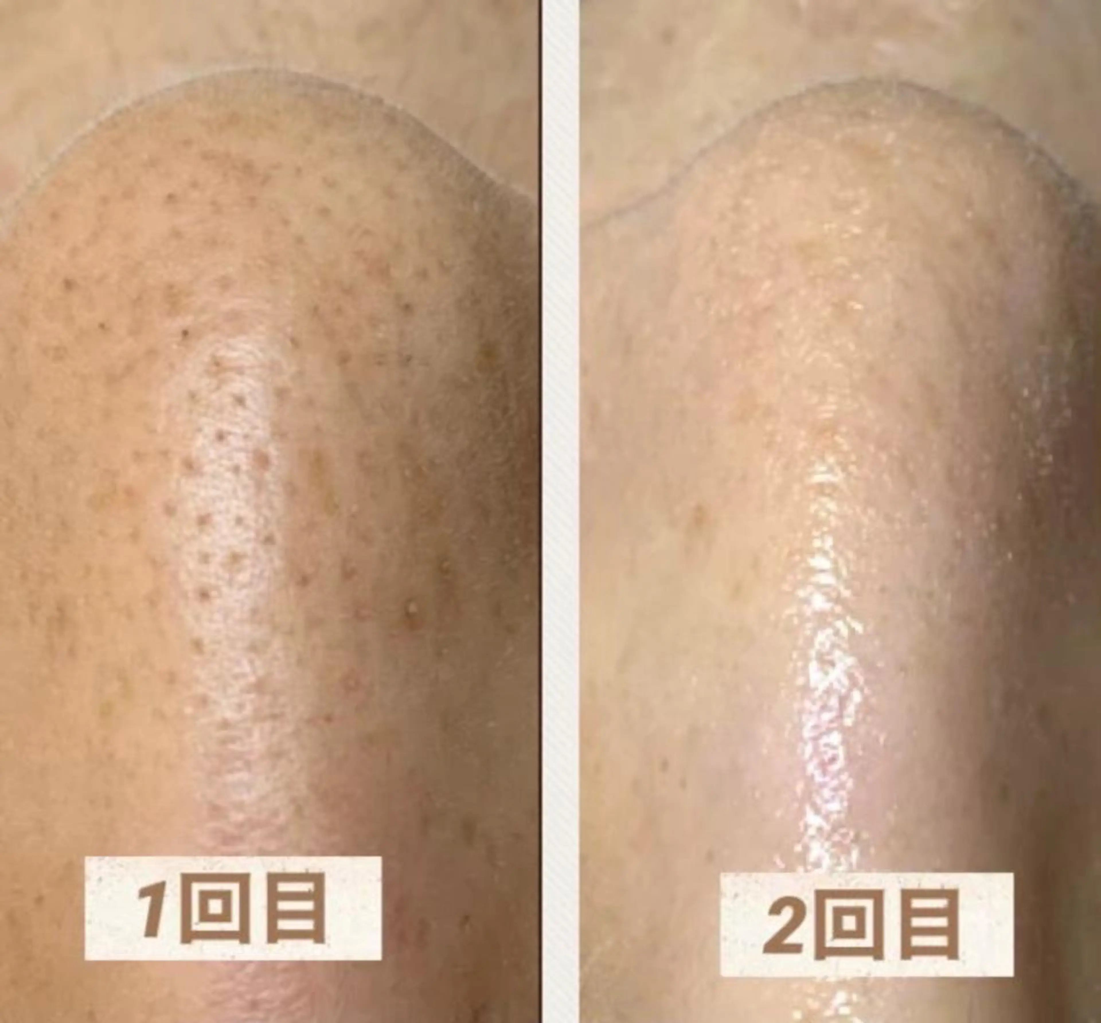 【毛穴エクストラクション】鼻のみ　施術箇所の写真掲載可能な方限定￥7000の写真