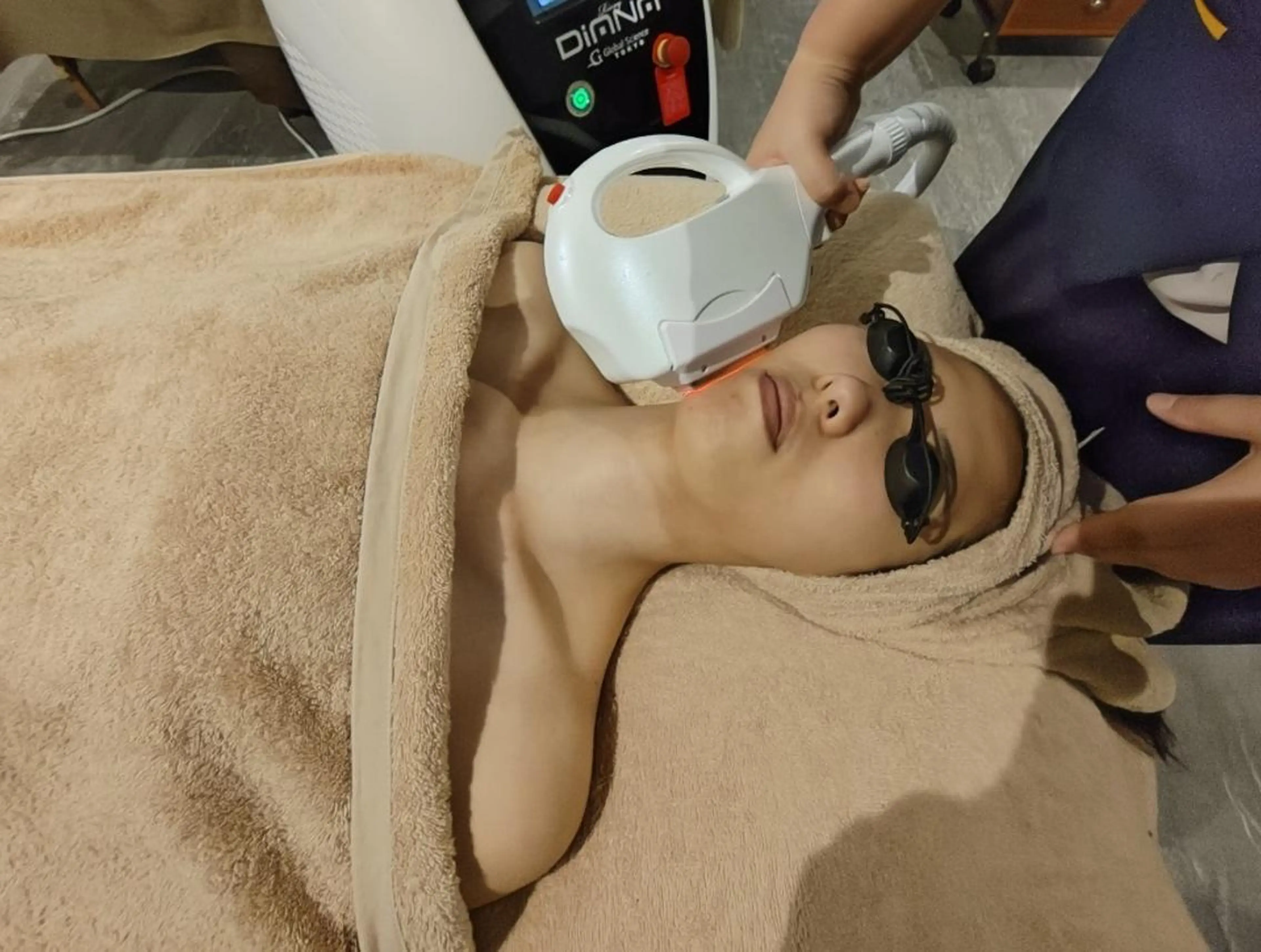 【産毛も◎トーンUP◎】スピート顔脱毛（眉上/眉間込み）　6600円の写真