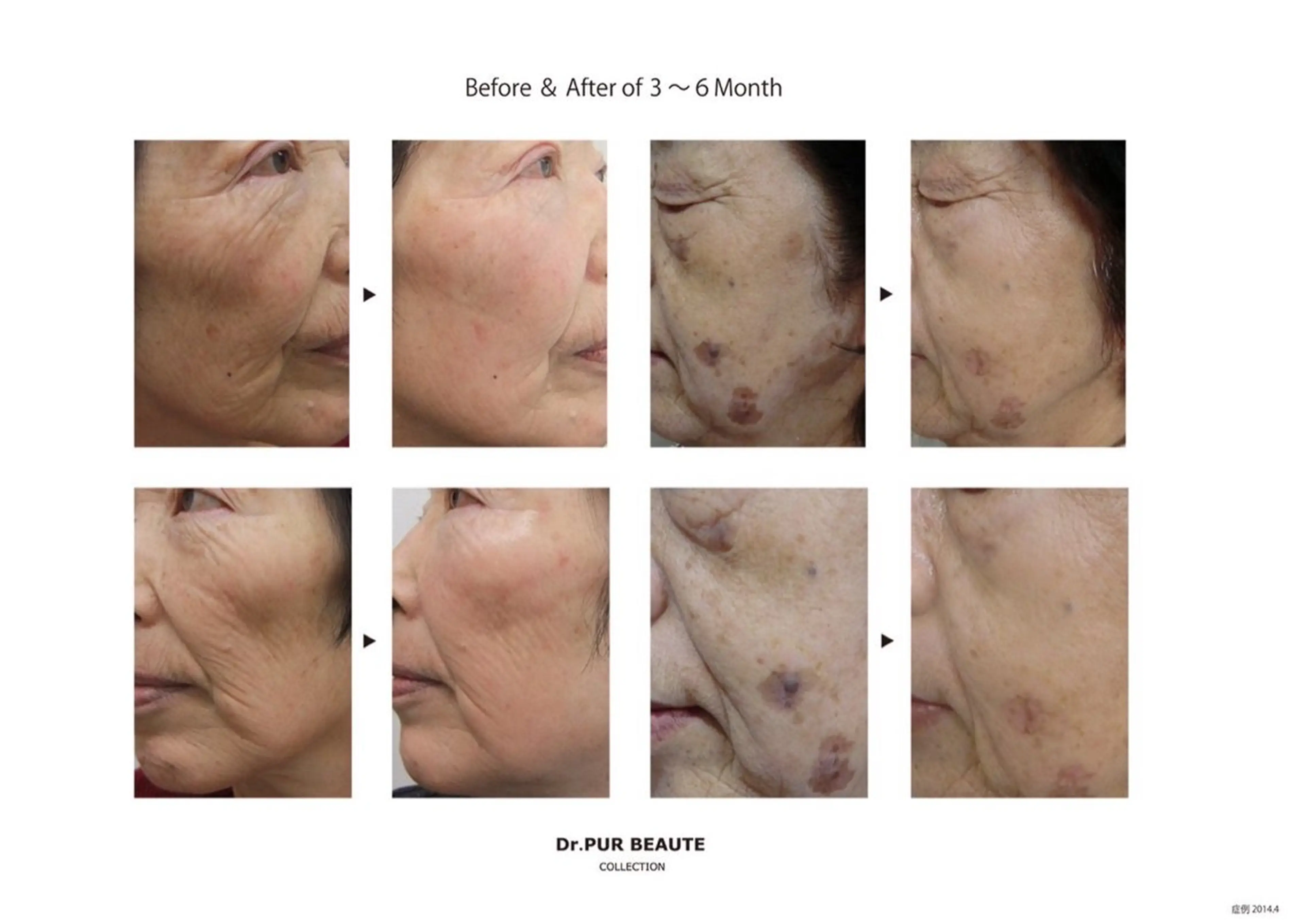 集中シミケア！代謝促進コース【2回分】の写真