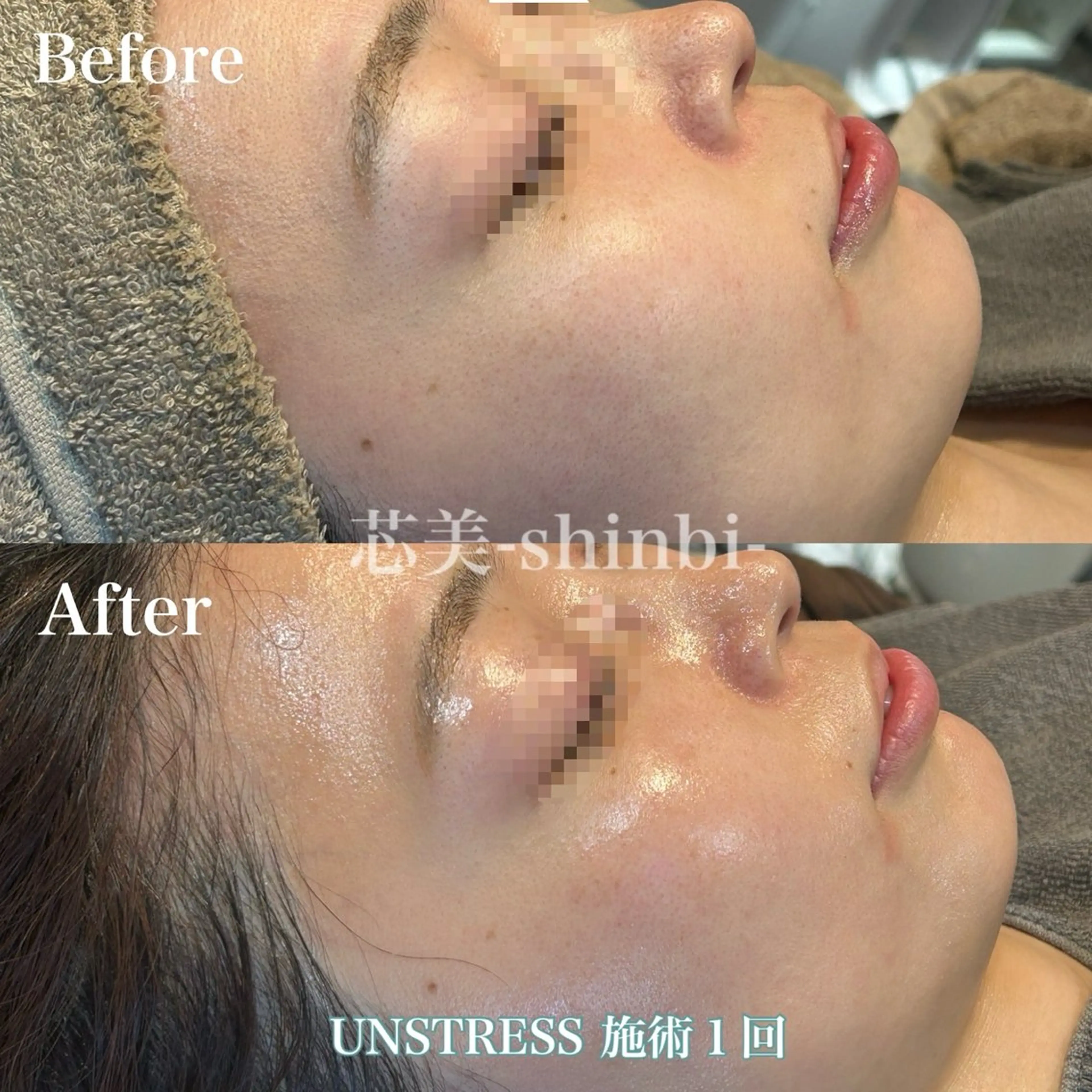 エステ 芯美-shinbi-所属・毛穴・ニキビケア ¦肌質改善¦EMIのエステ・リラクイメージ