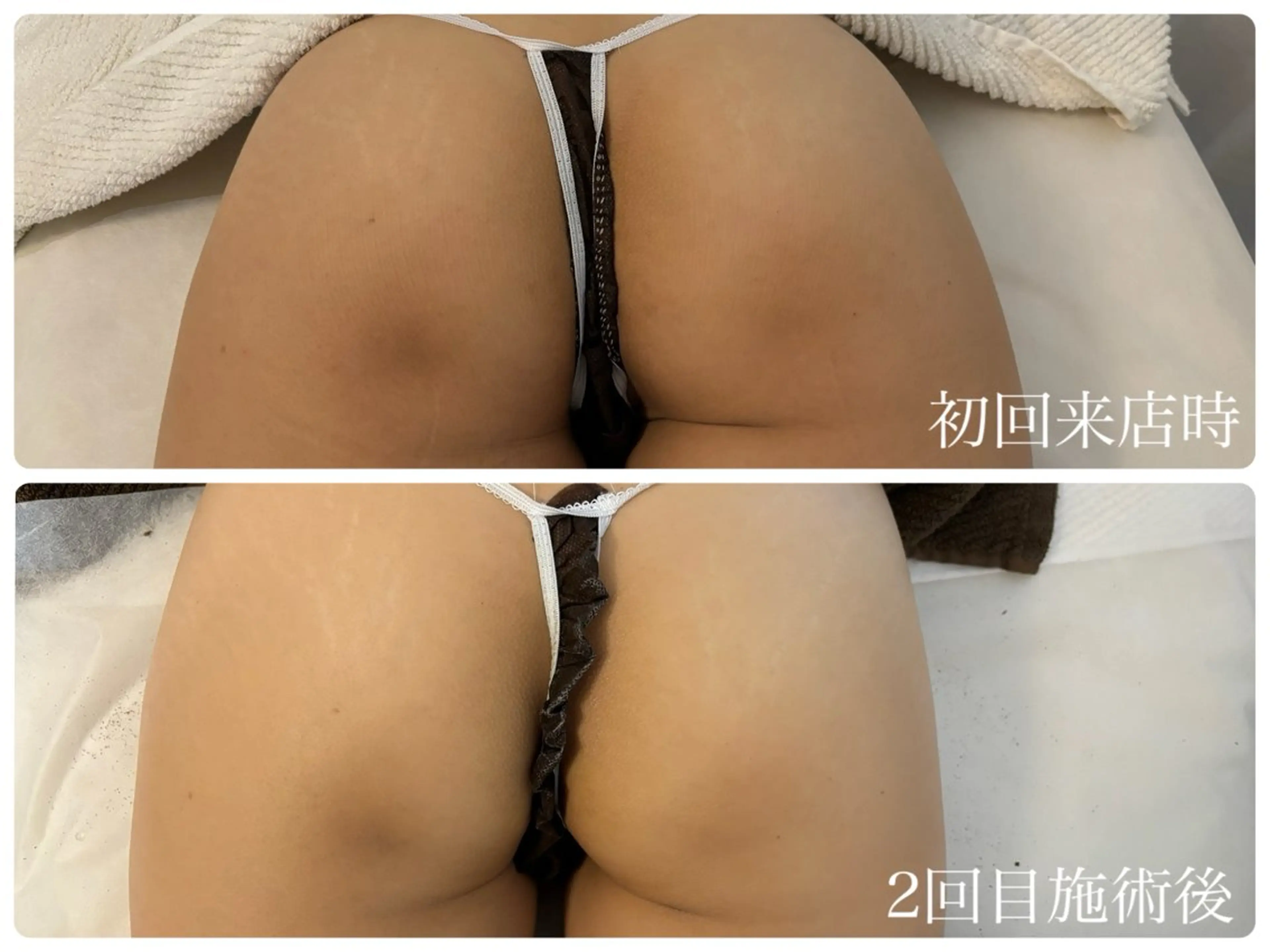 【お尻/ハーブピーリング】座りっぱなしでできる黒ずみやニキビ・ブツブツへの集中ケア🍑つるんとなめらかな触りたくなる肌にの写真