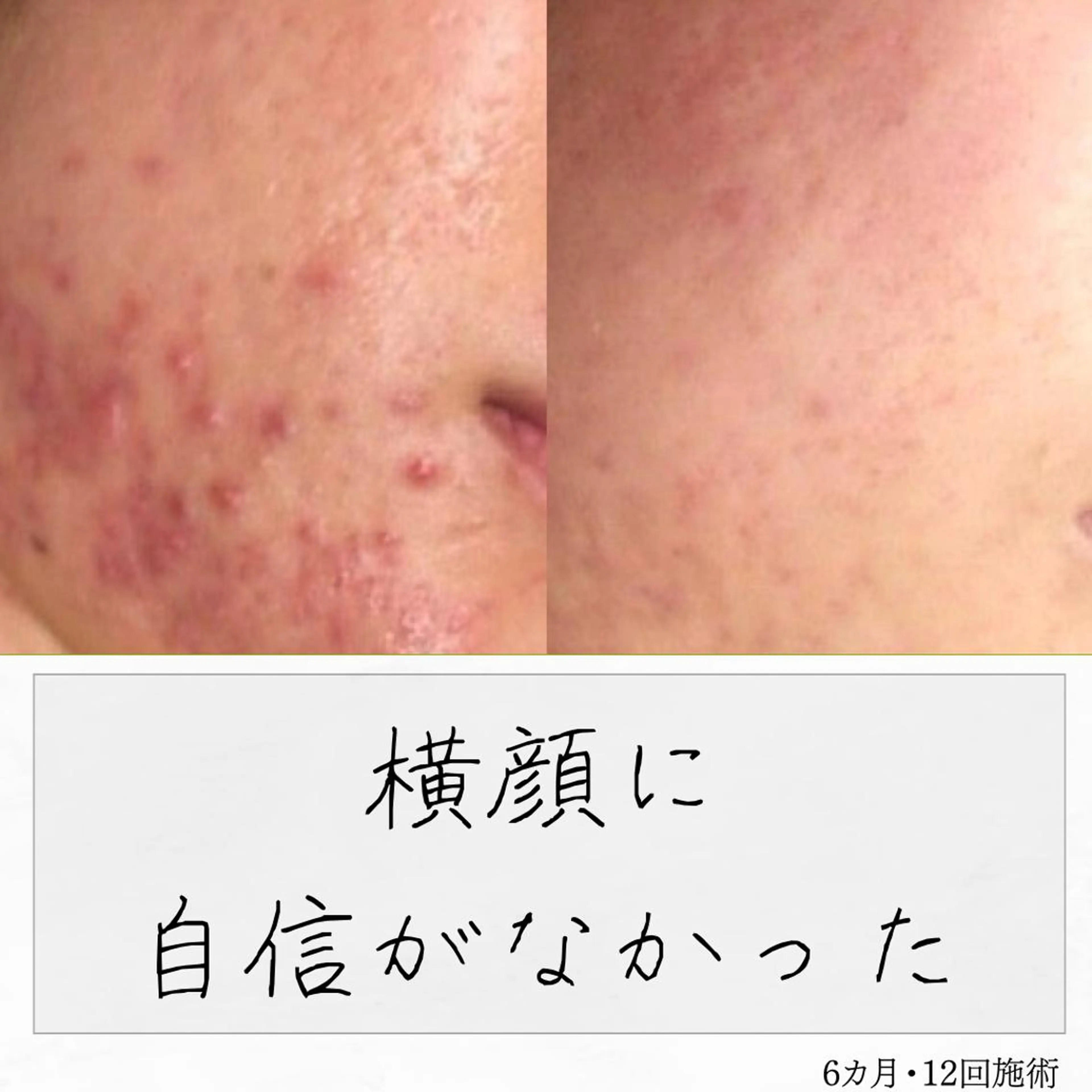 ニキビ経験者が施術 する専門サロン🌻のエステ・リラクイメージ