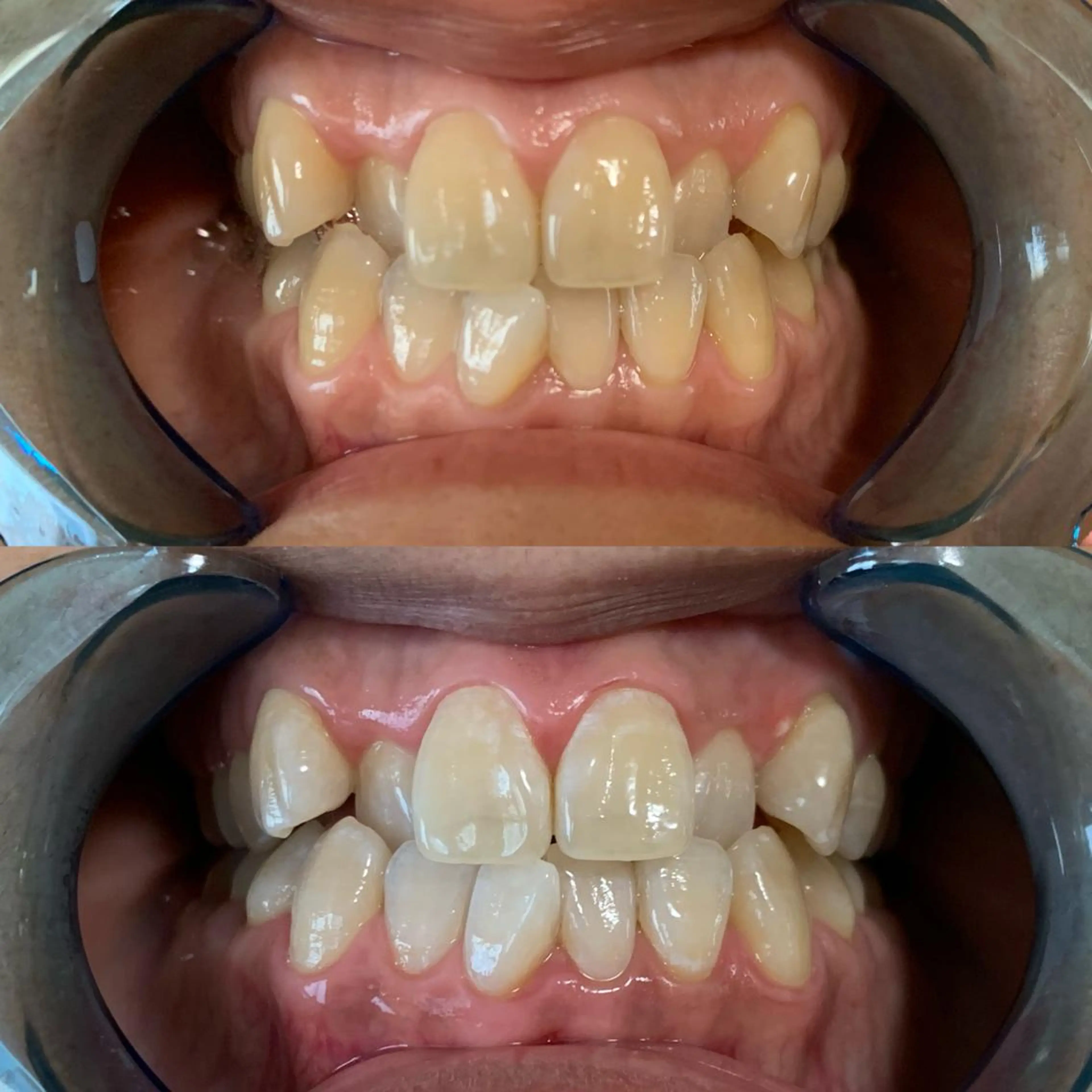 ホワイトニング🦷✨15分✖︎2回の写真