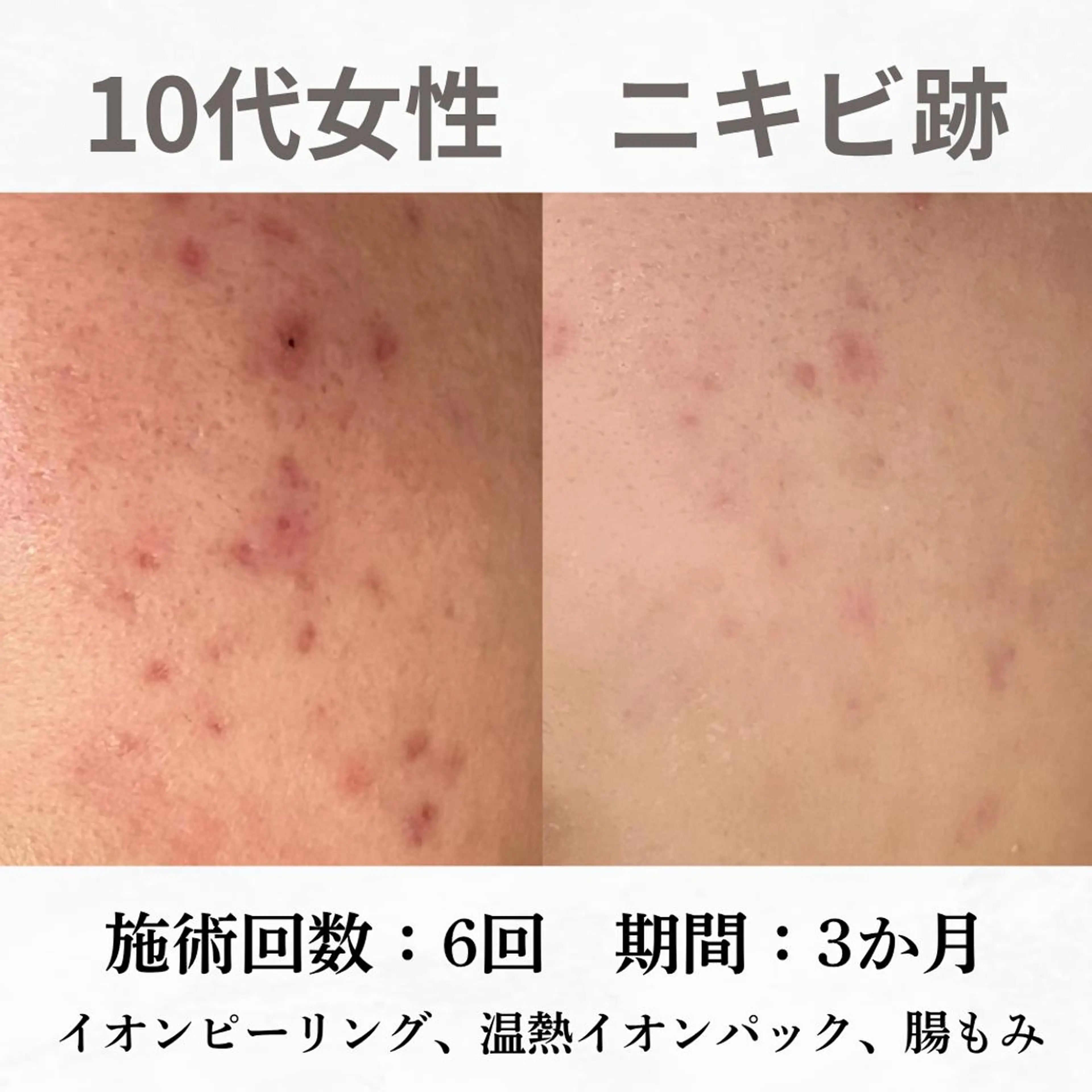 重度ニキビ専門🌷 ダウンタイムなしのエステ・リラクイメージ